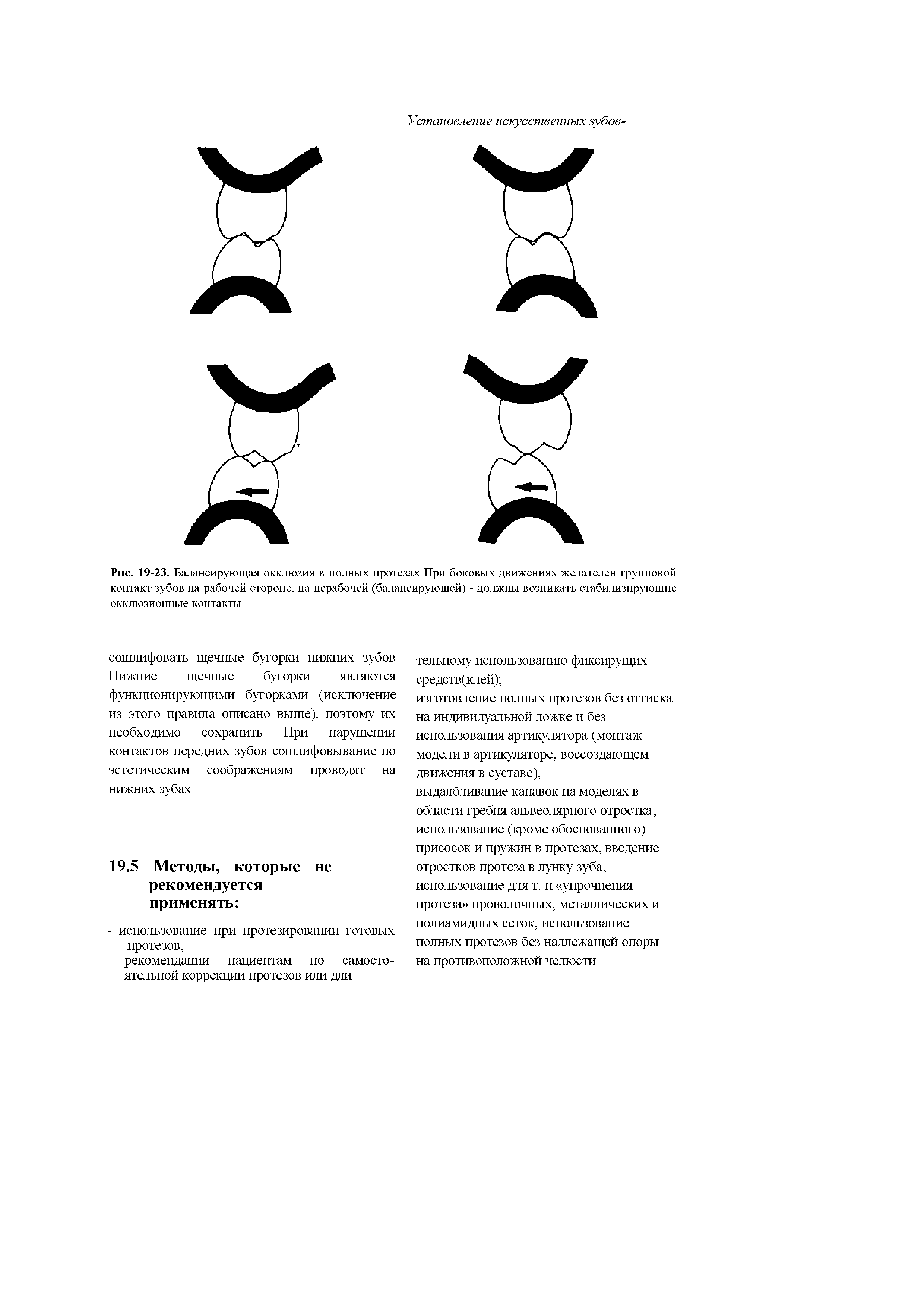 Рис. 19-23. Балансирующая окклюзия в полных протезах При боковых движениях желателен групповой контакт зубов на рабочей стороне, на нерабочей (балансирующей) - должны возникать стабилизирующие окклюзионные контакты...