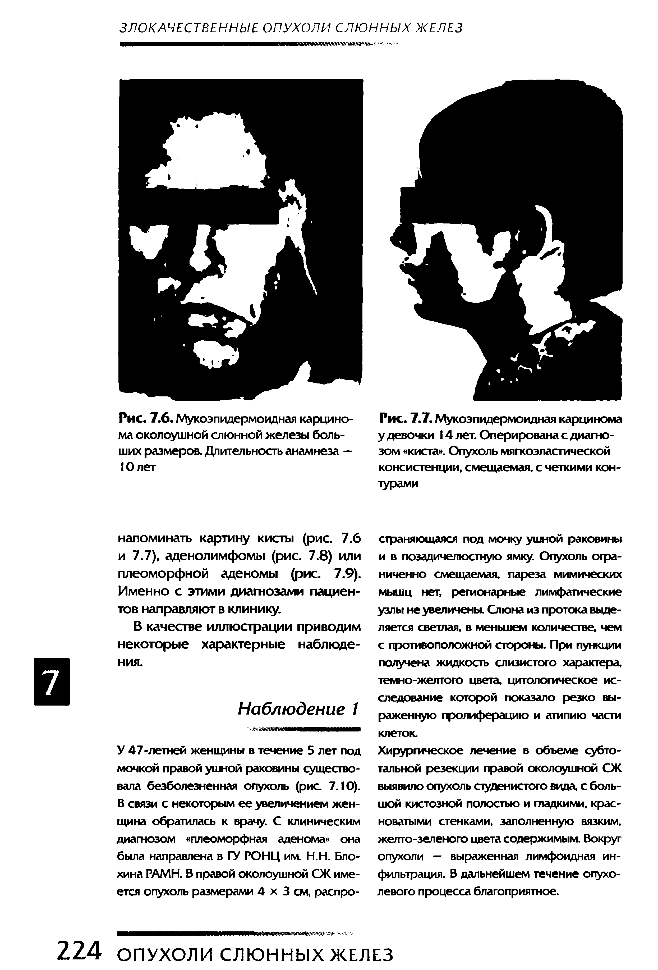 Рис. 7.6. Мукоэпидермоидная карцинома околоушной слюнной железы больших размеров. Длительность анамнеза — 10 лет...