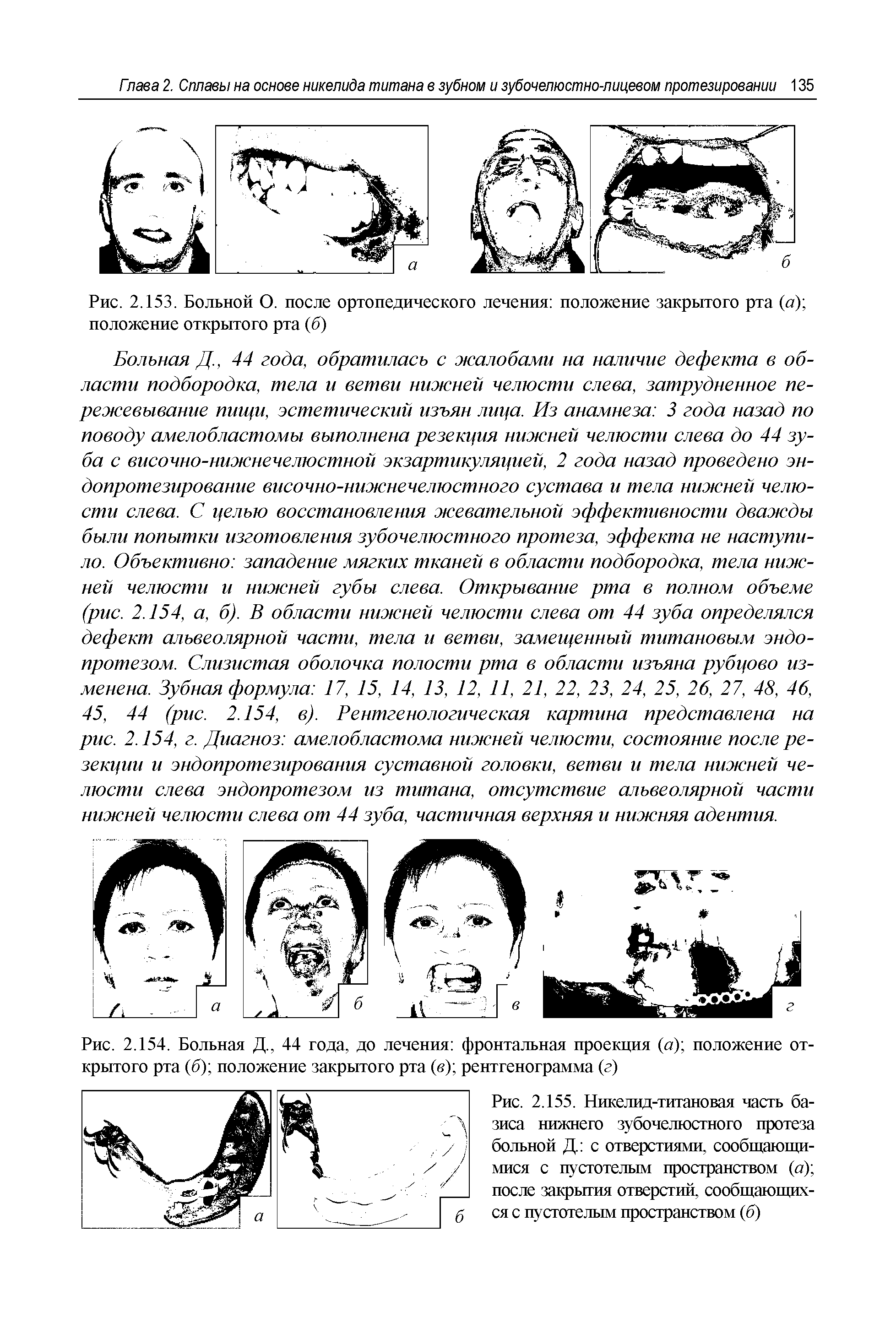 Рис. 2.155. Никелид-титановая часть базиса нижнего зубочелюстного протеза больной Д с отверстиями, сообщающимися с пустотелым пространством (а) после закрытия отверстий, сообщающихся с пустотелым пространством (б)...