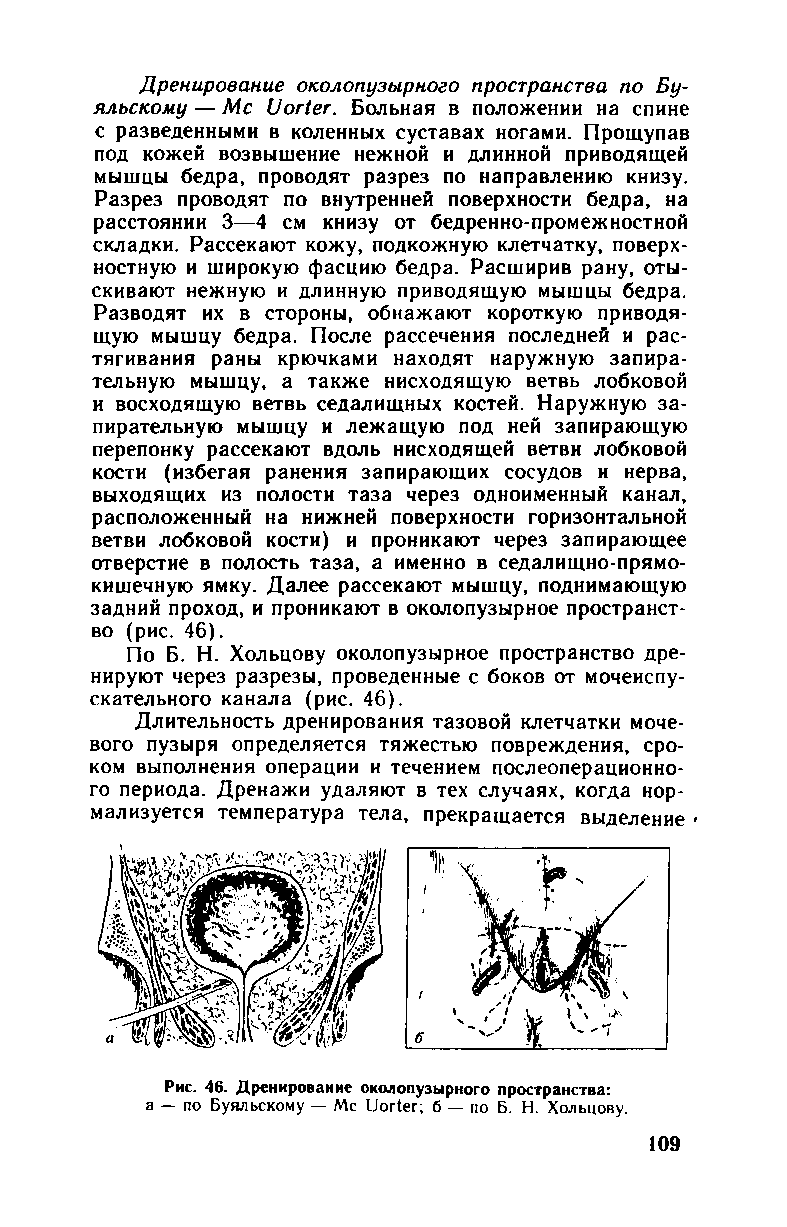 Рис. 46. Дренирование околопузырного пространства а — по Буяльскому — Мс ЫоКег б — по Б. Н. Хольцову.