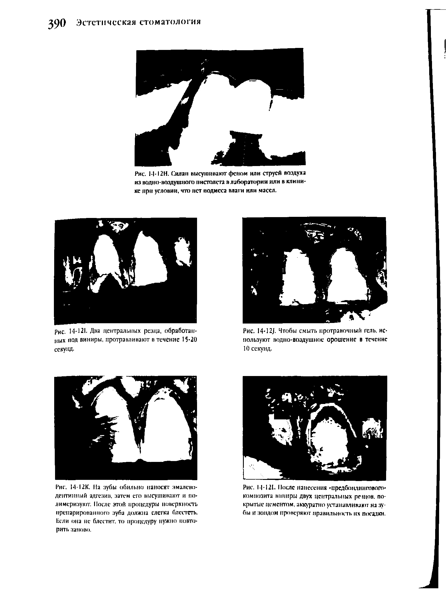 Рис. 14-12.). Чтобы смыть протравочный гель, используют водно-воздушное орошение в течение 10 секунд.