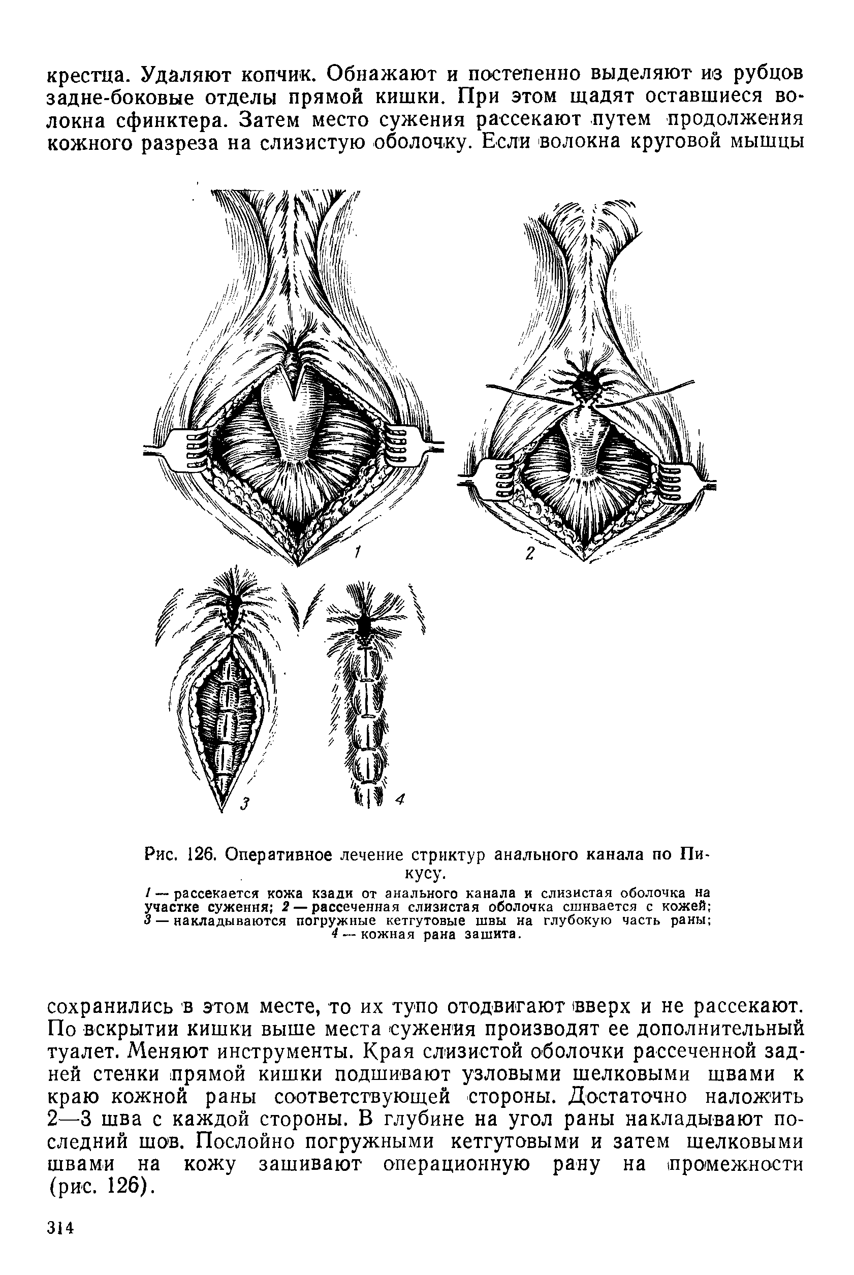 Рис. 126. Оперативное лечение стриктур анального канала по Пи-кусу.