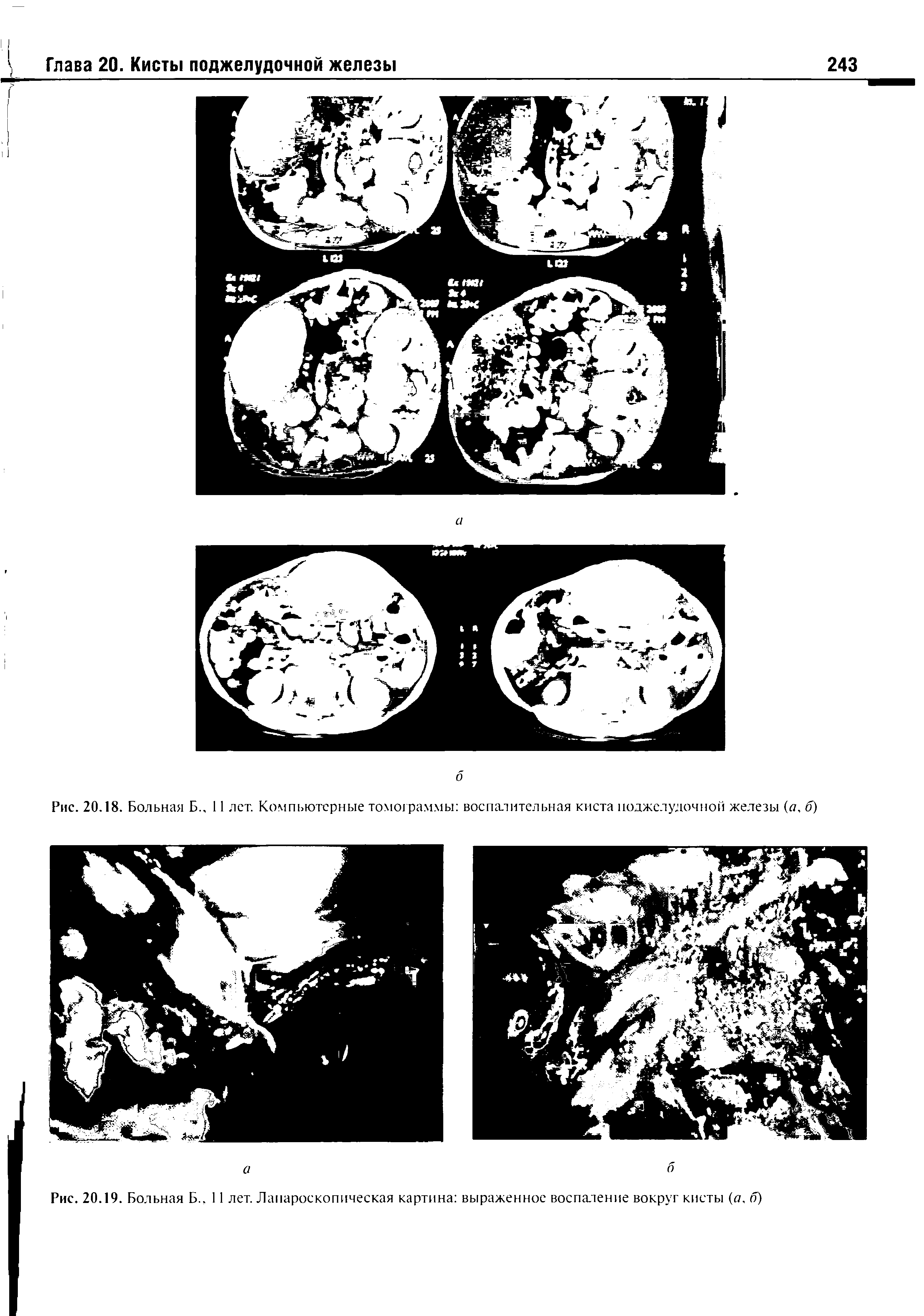 Рис. 20.18. Больная Б., 11 лет. Компьютерные томограммы воспалительная киста поджелудочной железы (о, б)...