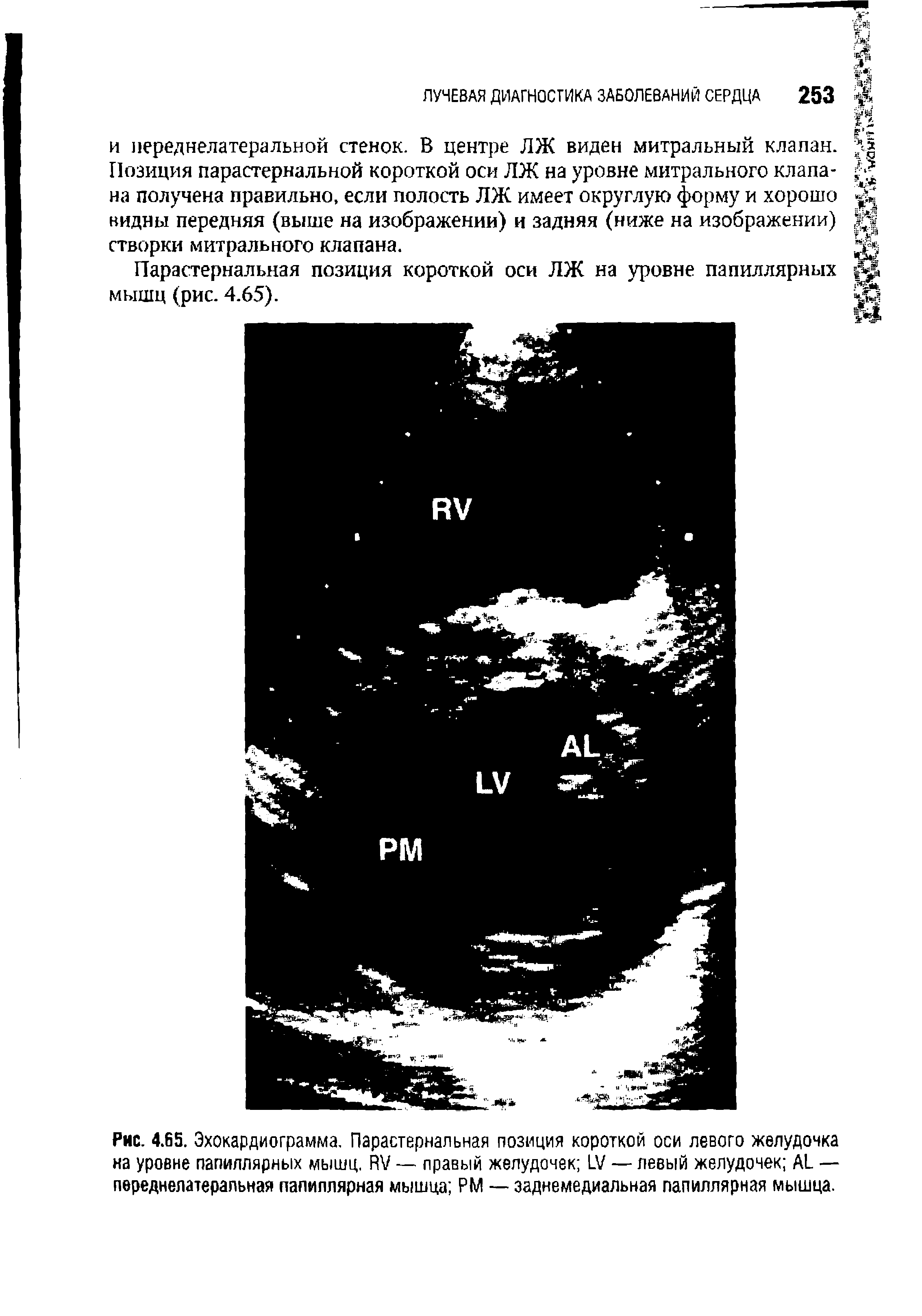 Рис. 4.В5. Эхокардиограмма. Парастернальная позиция короткой оси левого желудочка на уровне папиллярных мышц. ЯУ — правый желудочек V — левый желудочек АД — переднелатеральная папиллярная мышца РМ — заднемедиальная папиллярная мышца.