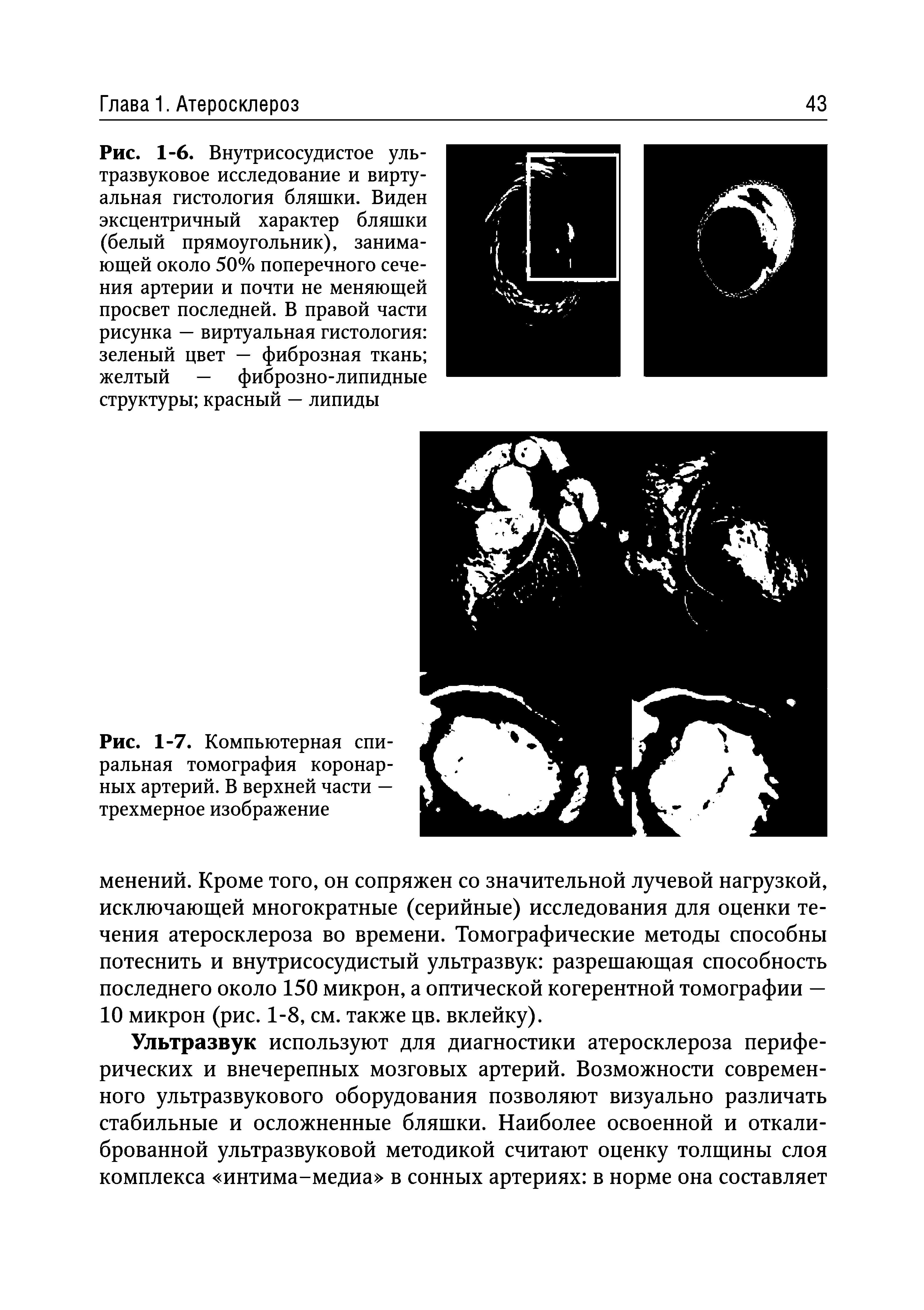 Рис. 1-7. Компьютерная спиральная томография коронарных артерий. В верхней части — трехмерное изображение...