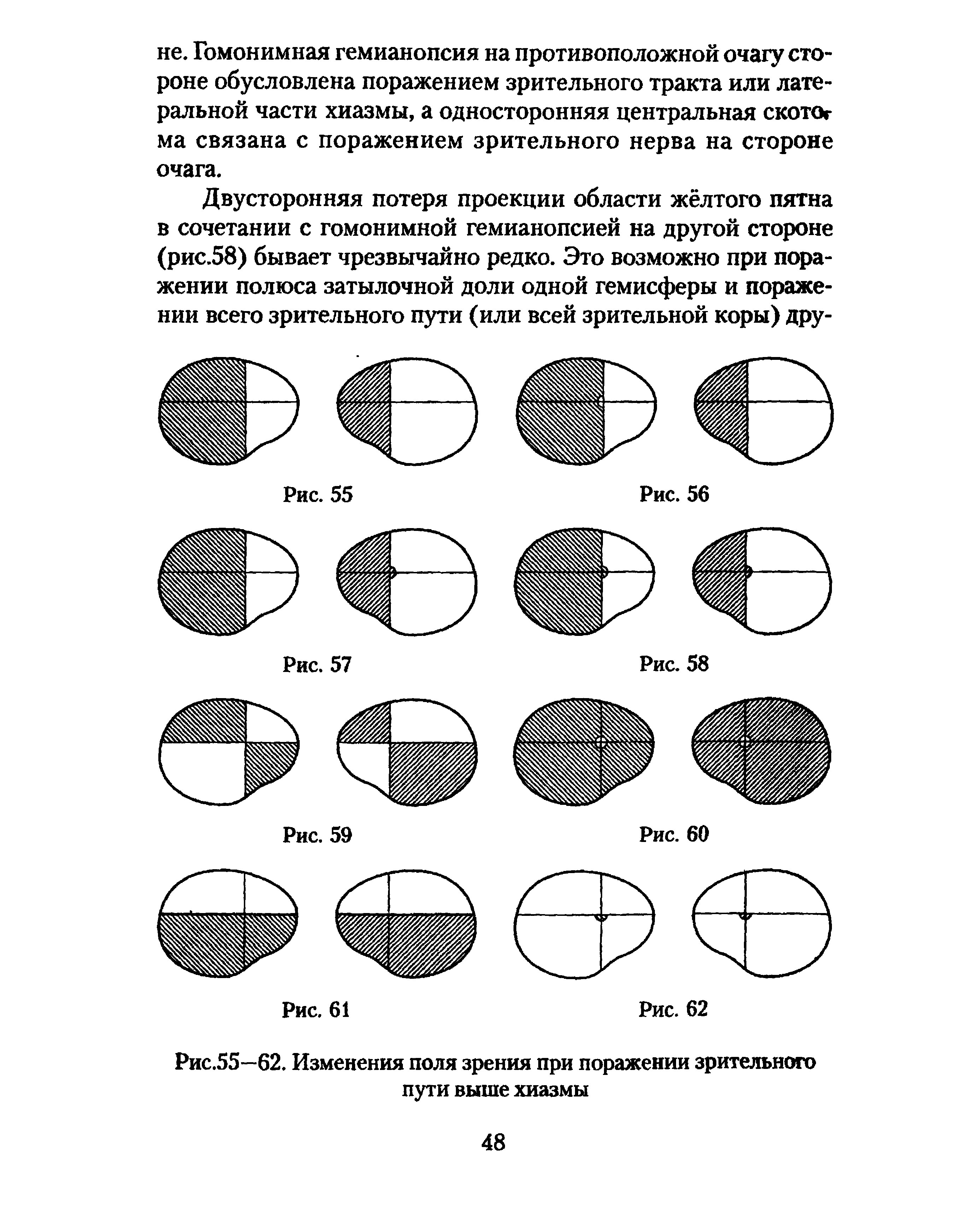 Рис.55—62. Изменения поля зрения при поражении зрительного пути выше хиазмы...