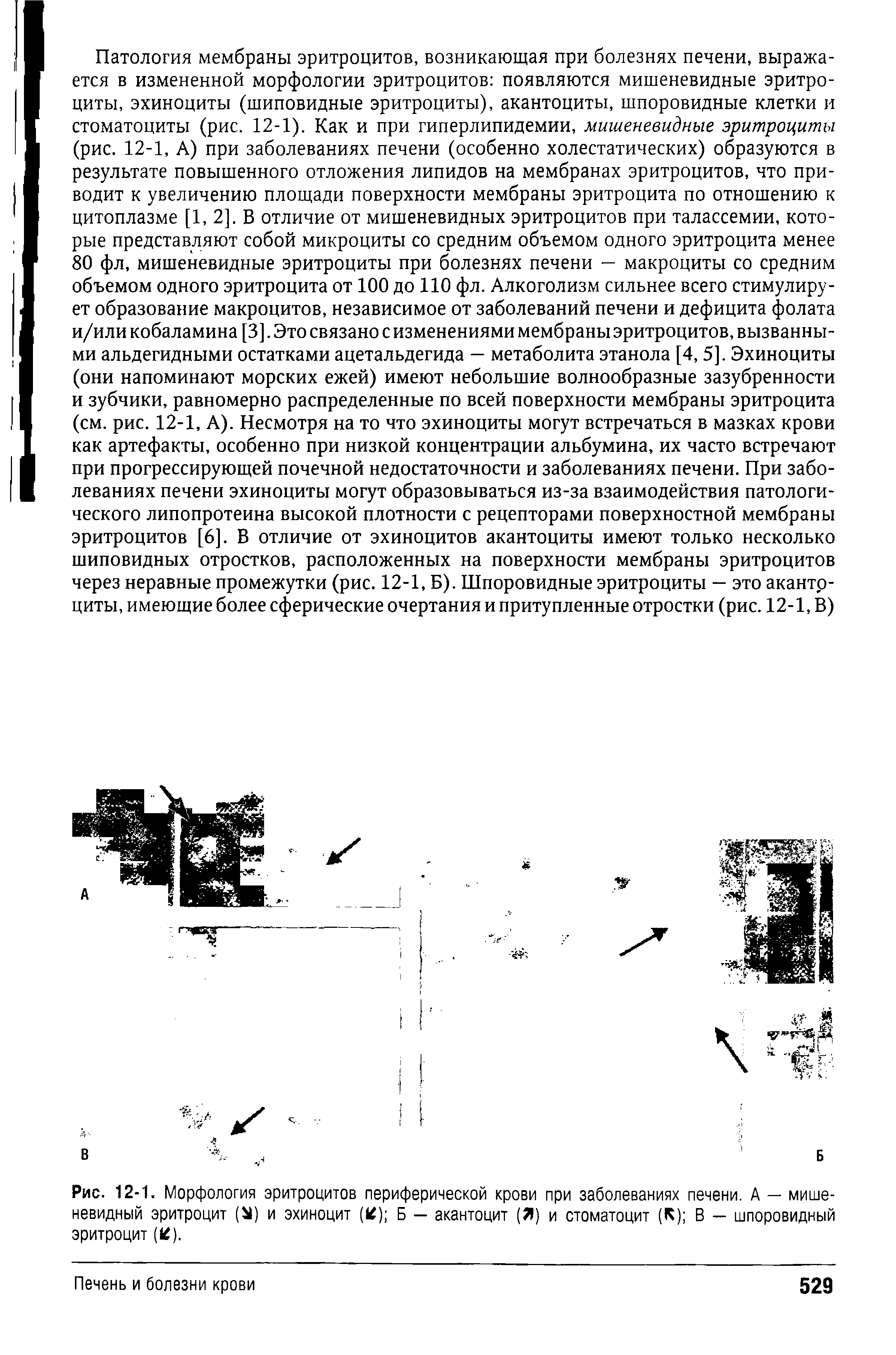 Рис. 12-1. Морфология эритроцитов периферической крови при заболеваниях печени. А — мишеневидный эритроцит (Ы) и эхиноцит (1 ) Б — акантоцит (Я) и стоматоцит (К) В — шпоровидный эритроцит ( ).