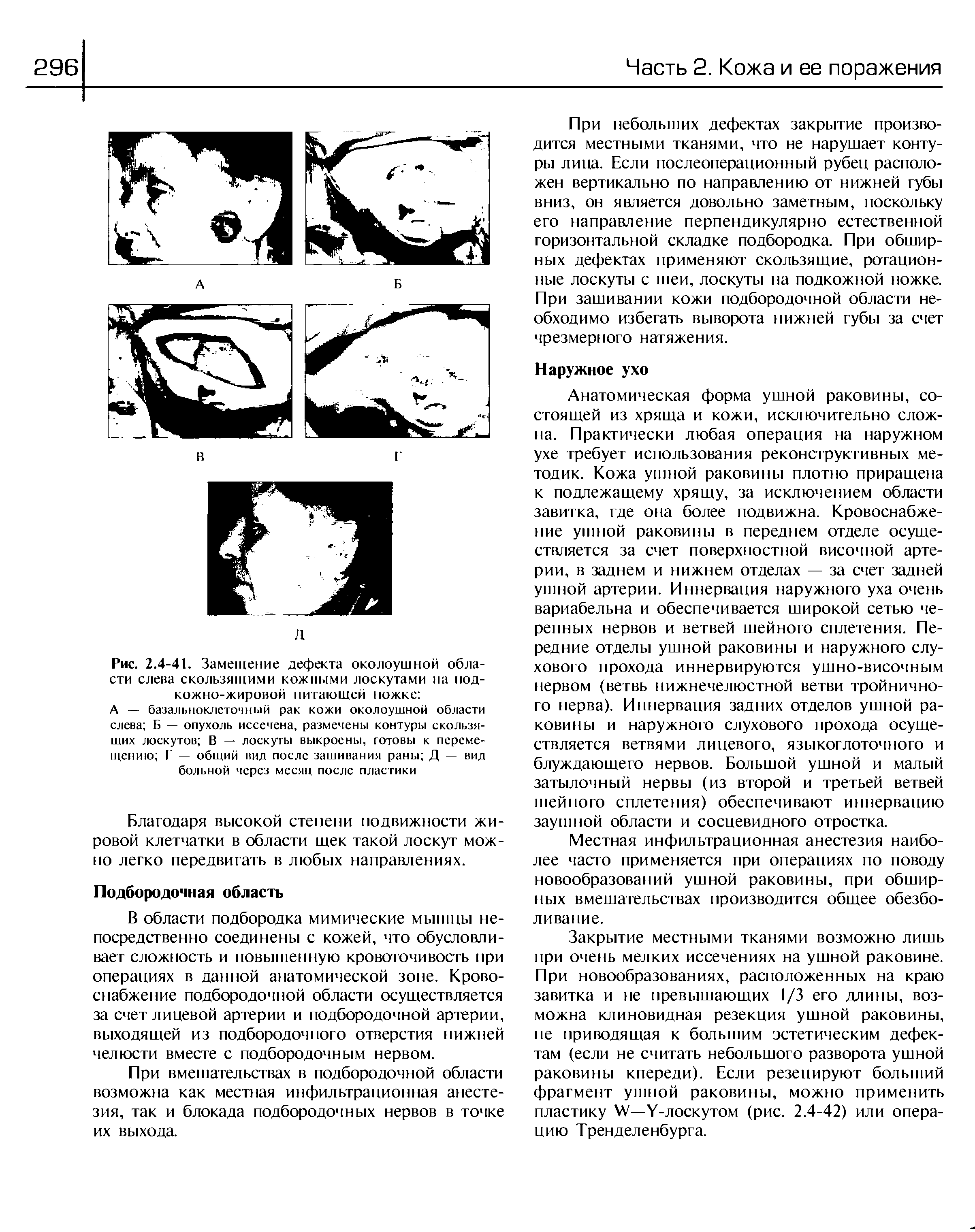 Рис. 2.4-41. Замещение дефекта околоушной области слева скользящими кожными лоскутами на подкожно-жировой питающей ножке ...