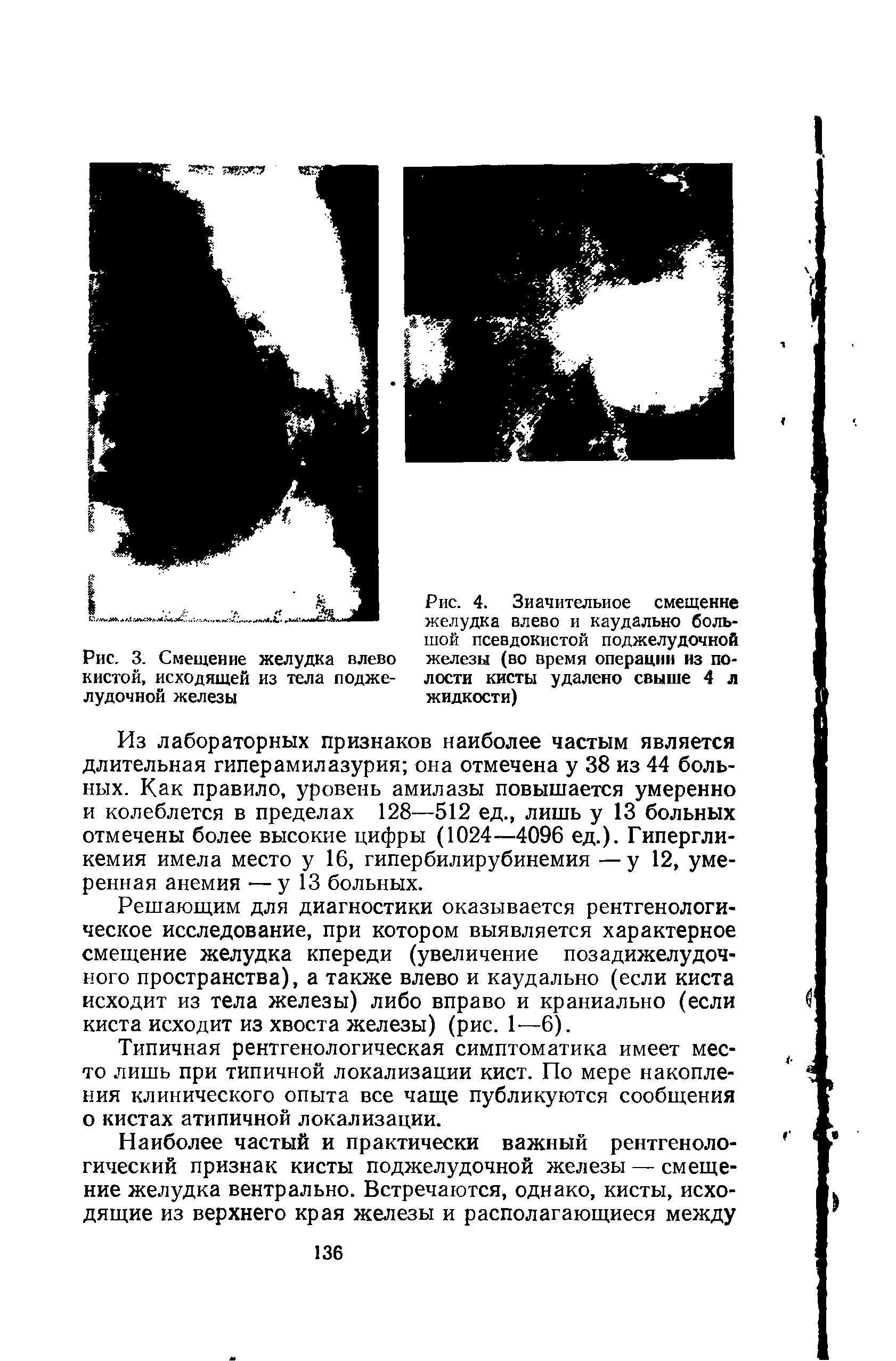 Рис. 4. Значительное смещение желудка влево и каудально большой псевдокистой поджелудочной железы (во время операции из полости кисты удалено свыше 4 л жидкости)...