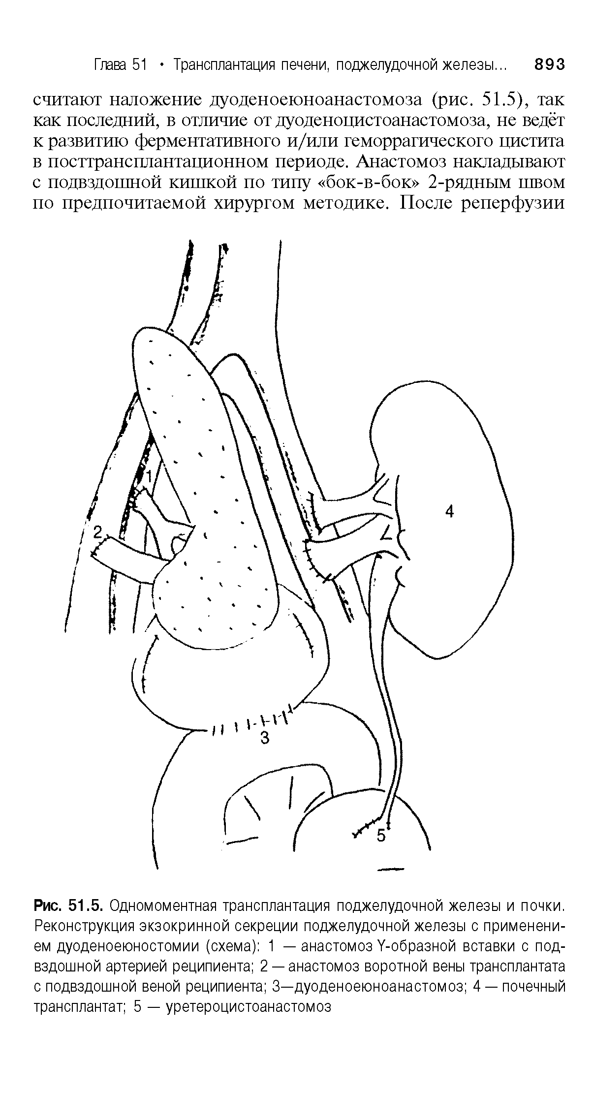 Рис. 51.5. Одномоментная трансплантация поджелудочной железы и почки. Реконструкция экзокринной секреции поджелудочной железы с применением дуоденоеюностомии (схема) 1 — анастомоз У-образной вставки с подвздошной артерией реципиента 2 —анастомоз воротной вены трансплантата с подвздошной веной реципиента 3—дуоденоеюноанастомоз 4 — почечный трансплантат 5 — уретероцистоанастомоз...
