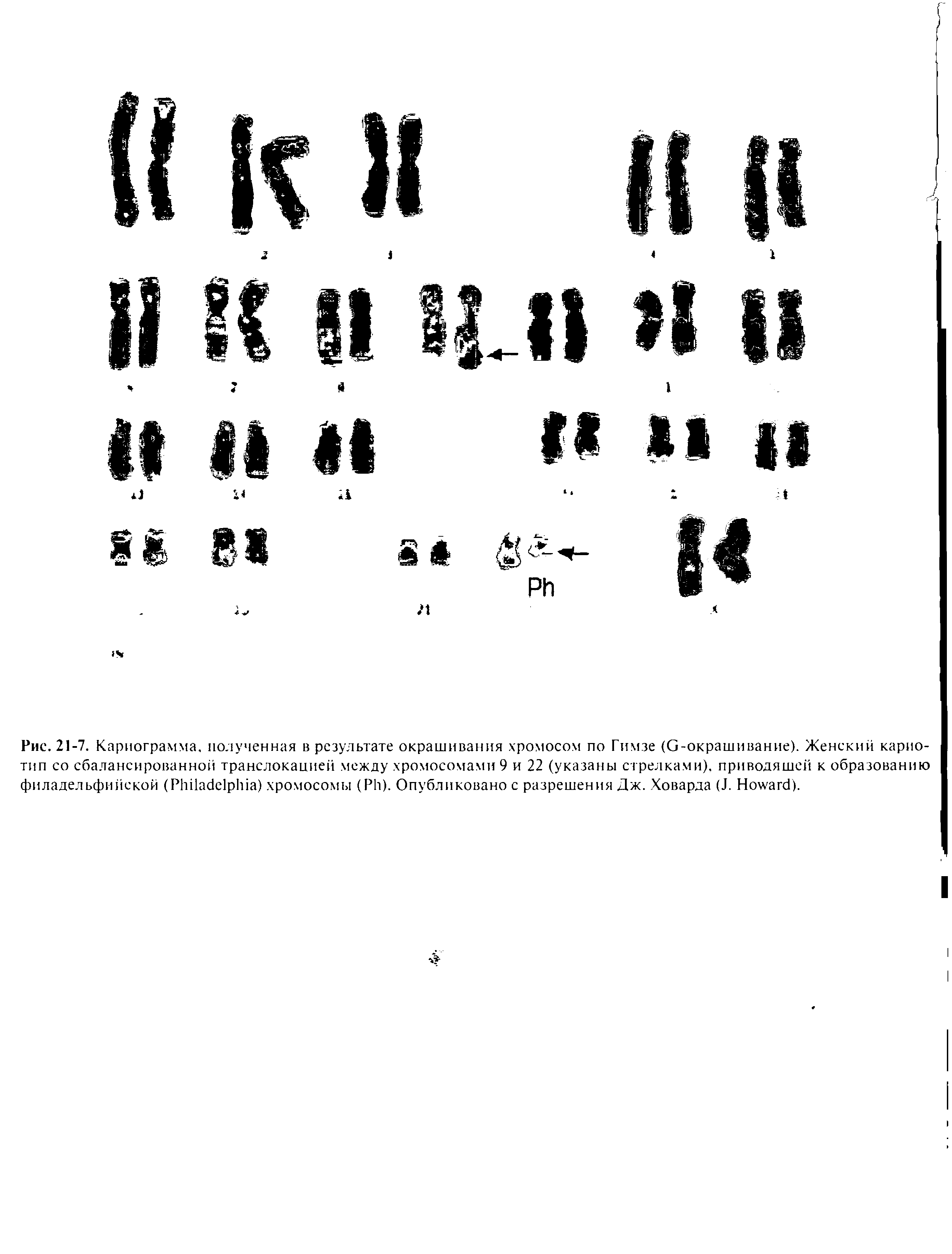 Рис. 21-7. Кариограмма, полученная в результате окрашивания хромосом по Гимзе (G-окрашивание). Женский кариотип со сбалансированной транслокацией между хромосомами 9 и 22 (указаны стрелками), приводящей к образованию филадельфийской (P ) хромосомы (P ). Опубликовано с разрешения Дж. Ховарда (J. H ).