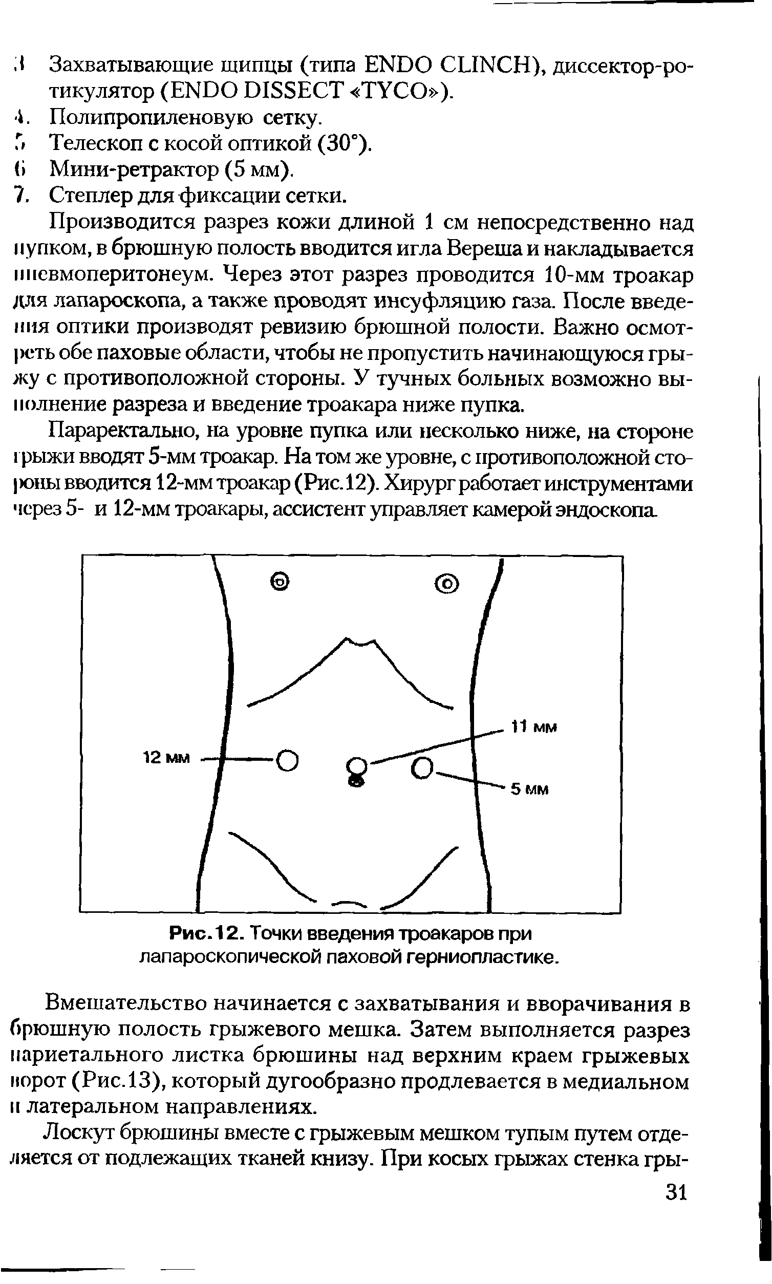 Рис. 12. Точки введения троакаров при лапароскопической паховой герниопластике.