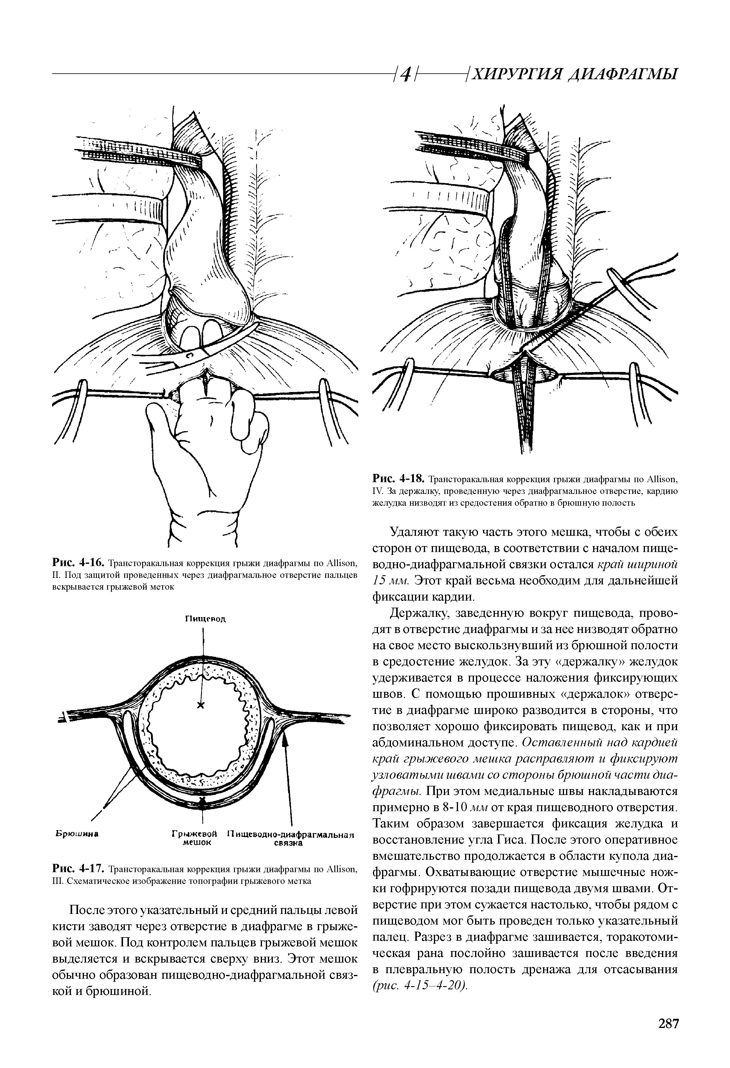 Рис. 4-16. Трансторакальная коррекция грыжи диафрагмы по A , II. Под защитой проведенных через диафрагмальное отверстие пальцев вскрывается грыжевой меток...