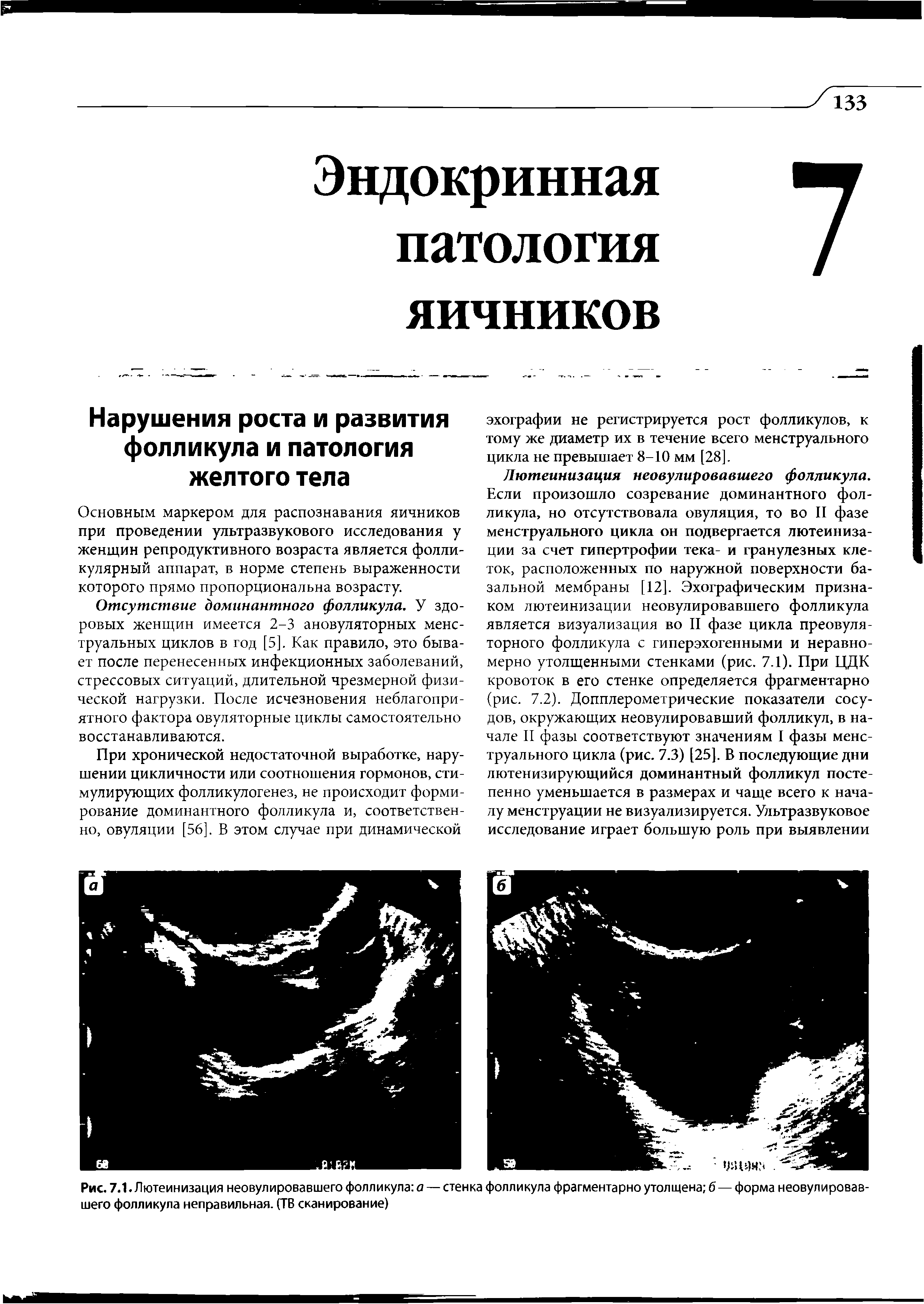 Рис. 7.1. Лютеинизация неовулировавшего фолликула а — стенка фолликула фрагментарно утолщена б — форма неовулировавшего фолликула неправильная. (ТВ сканирование)...