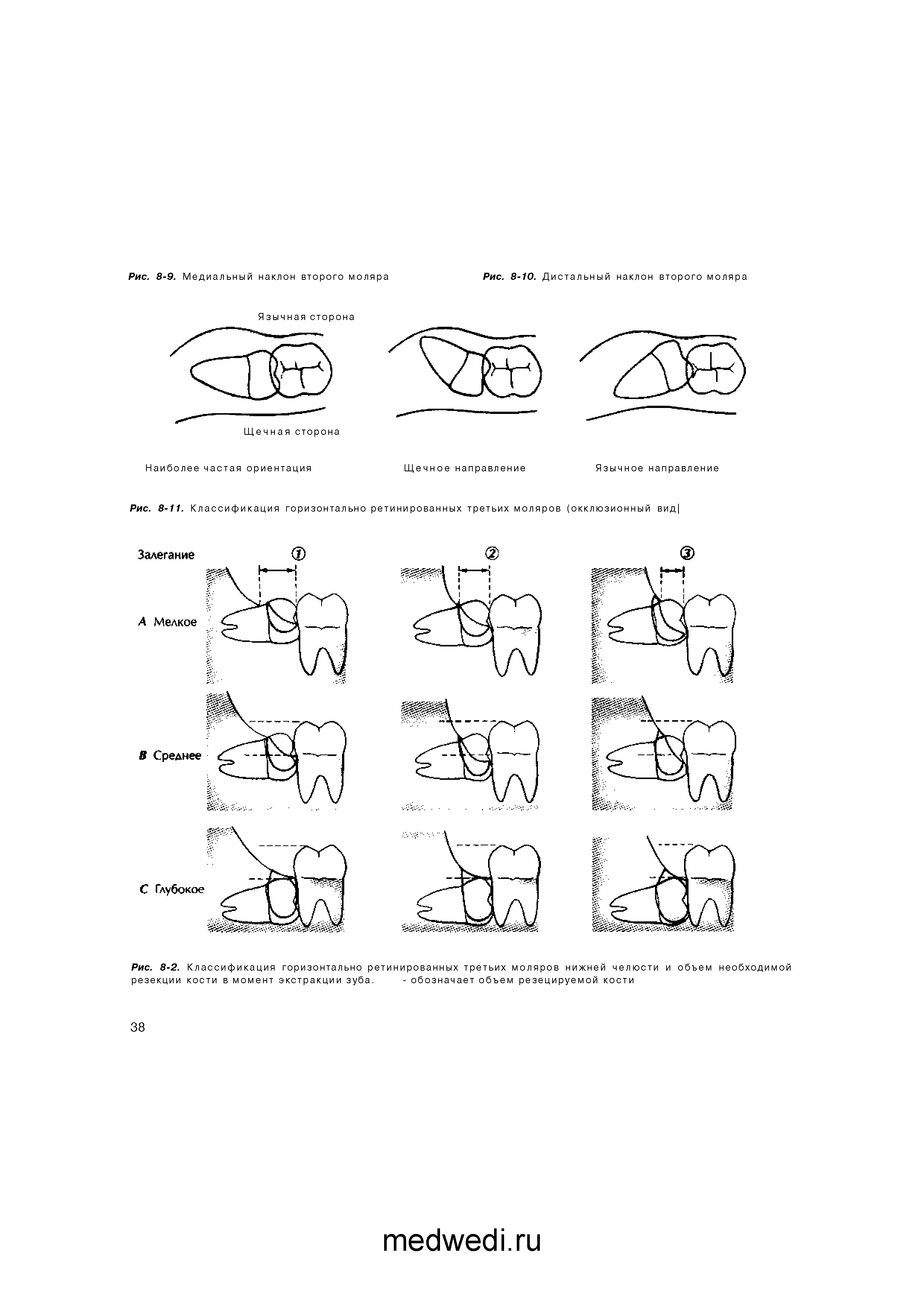 Рис. 8-2. Классификация горизонтально ретинированных третьих моляров нижней челюсти и объем необходимой резекции кости в момент экстракции зуба. - обозначает объем резецируемой кости...