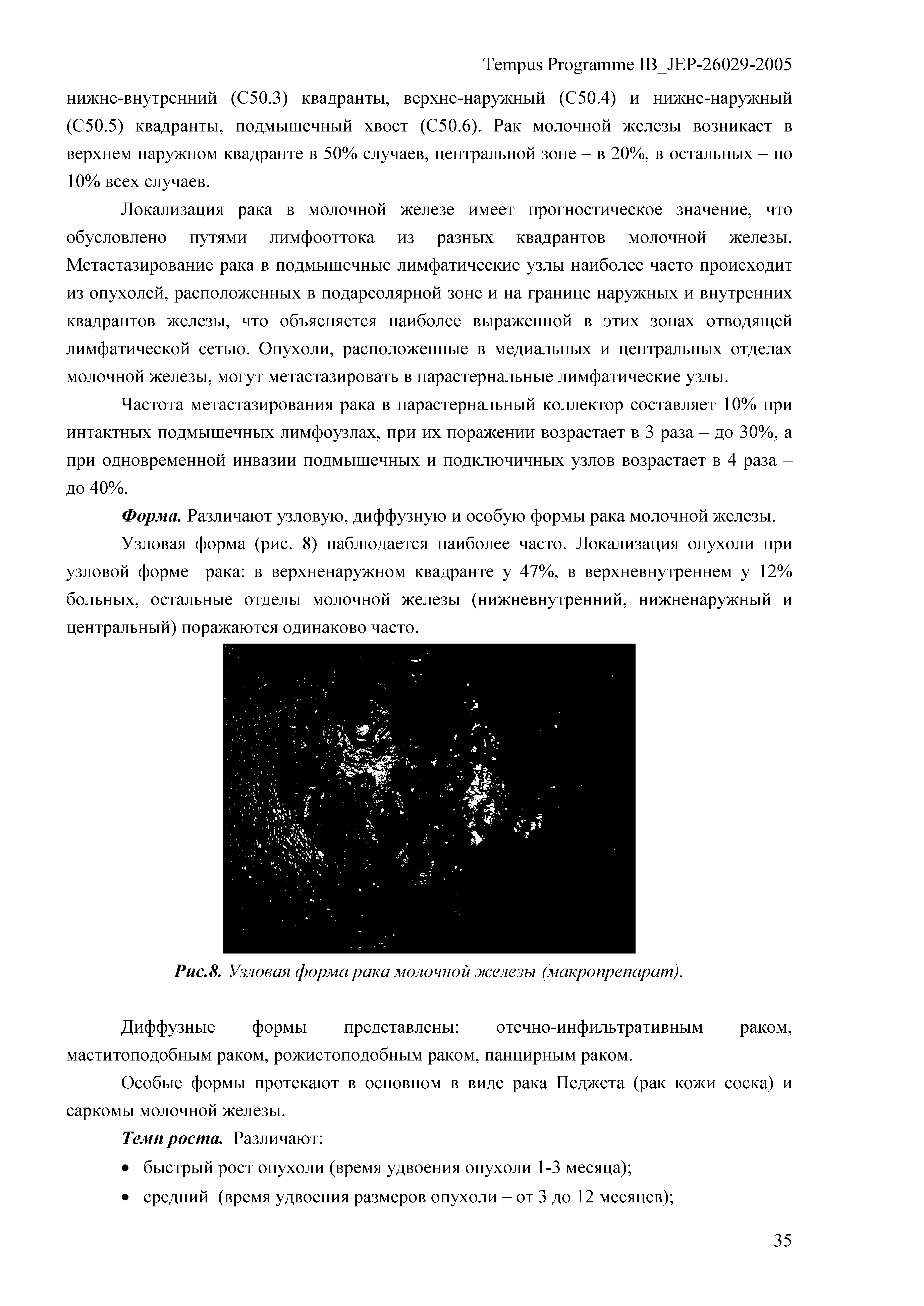 Рис.8. Узловая форма рака молочной железы (макропрепарат).