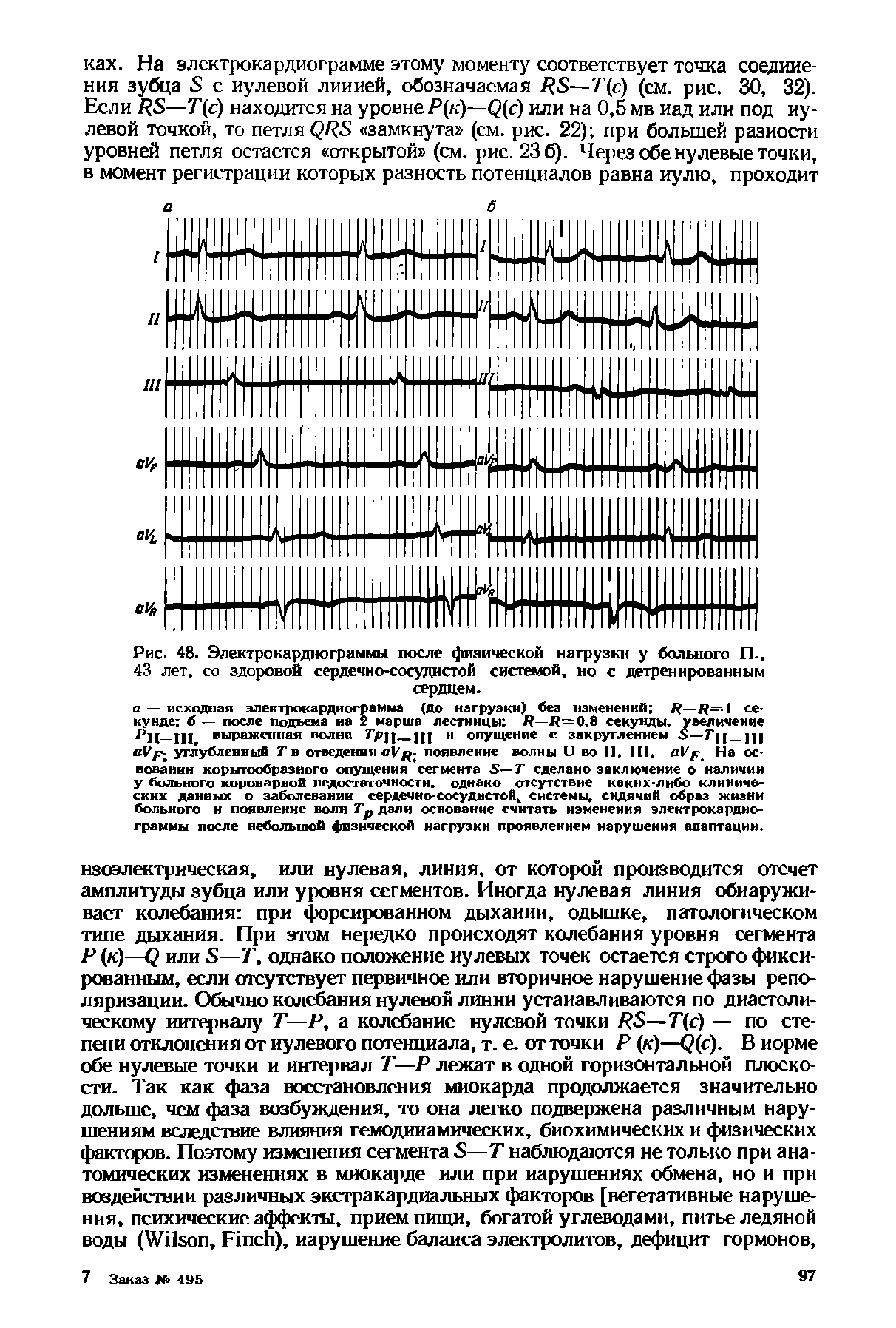 Рис. 48. Электрокардиограммы после физической нагрузки у больного П. 43 лет, со здоровой сердечно-сосудистой системой, но с детренированным сердцем.
