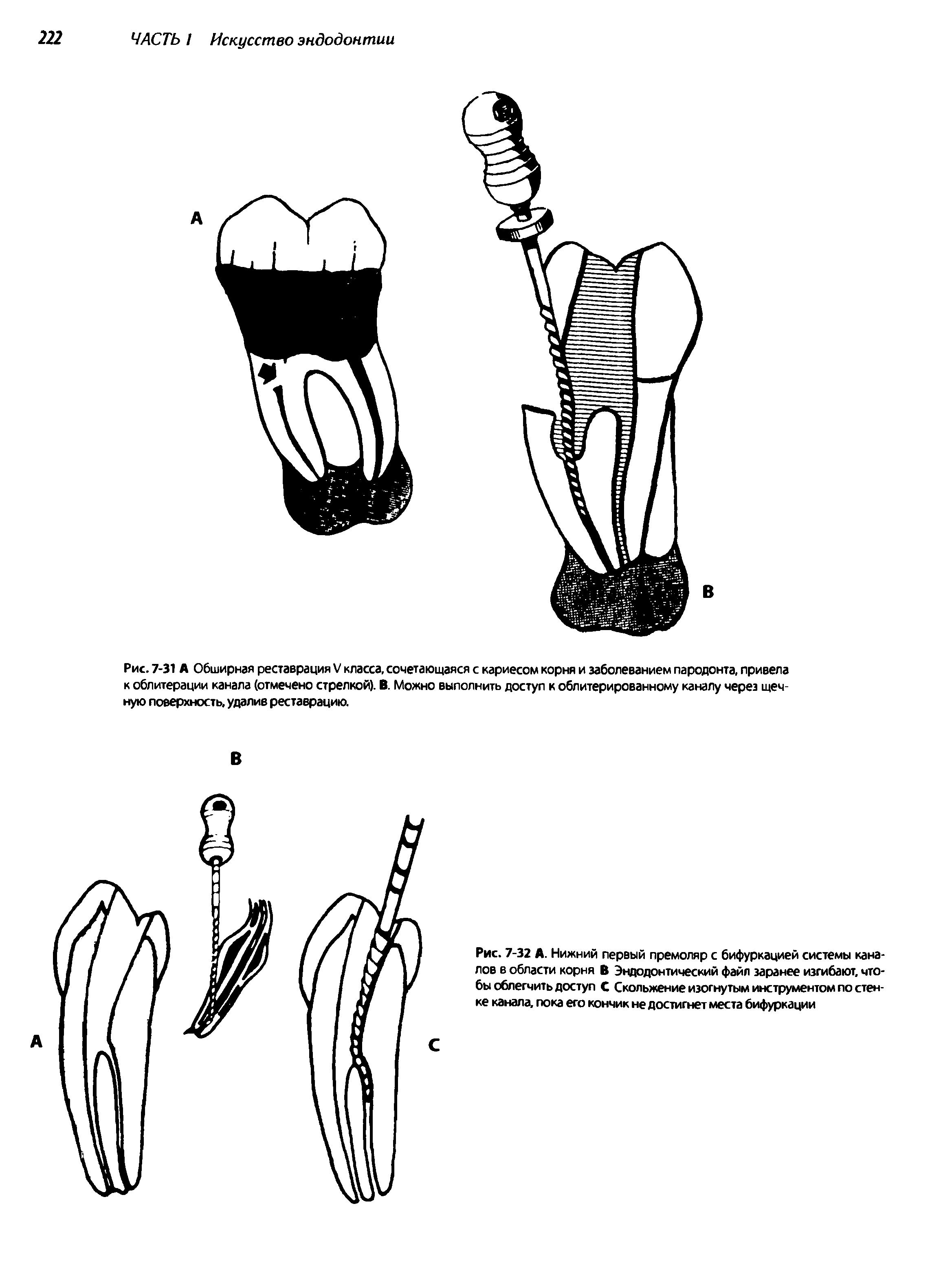 Рис. 7-32 А. Нижний первый премоляр с бифуркацией системы каналов в области корня В Эндодонтический файл заранее изгибают, чтобы облегчить доступ С Скольжение изогнутым инструментом по стенке канала, пока его кончик не достигнет места бифуркации...