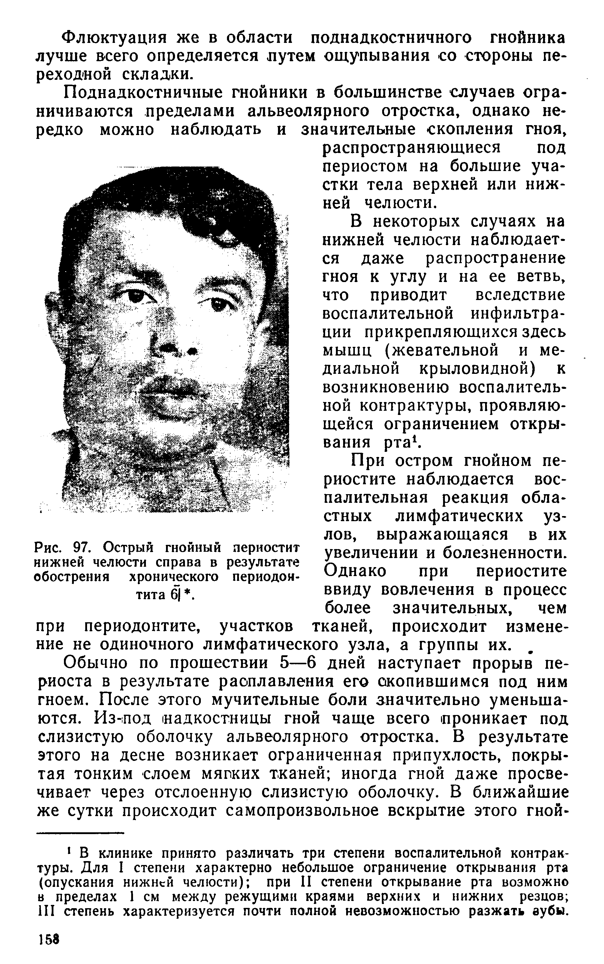 Рис. 97. Острый гнойный периостит нижней челюсти справа в результате обострения хронического периодонтита 6. ...