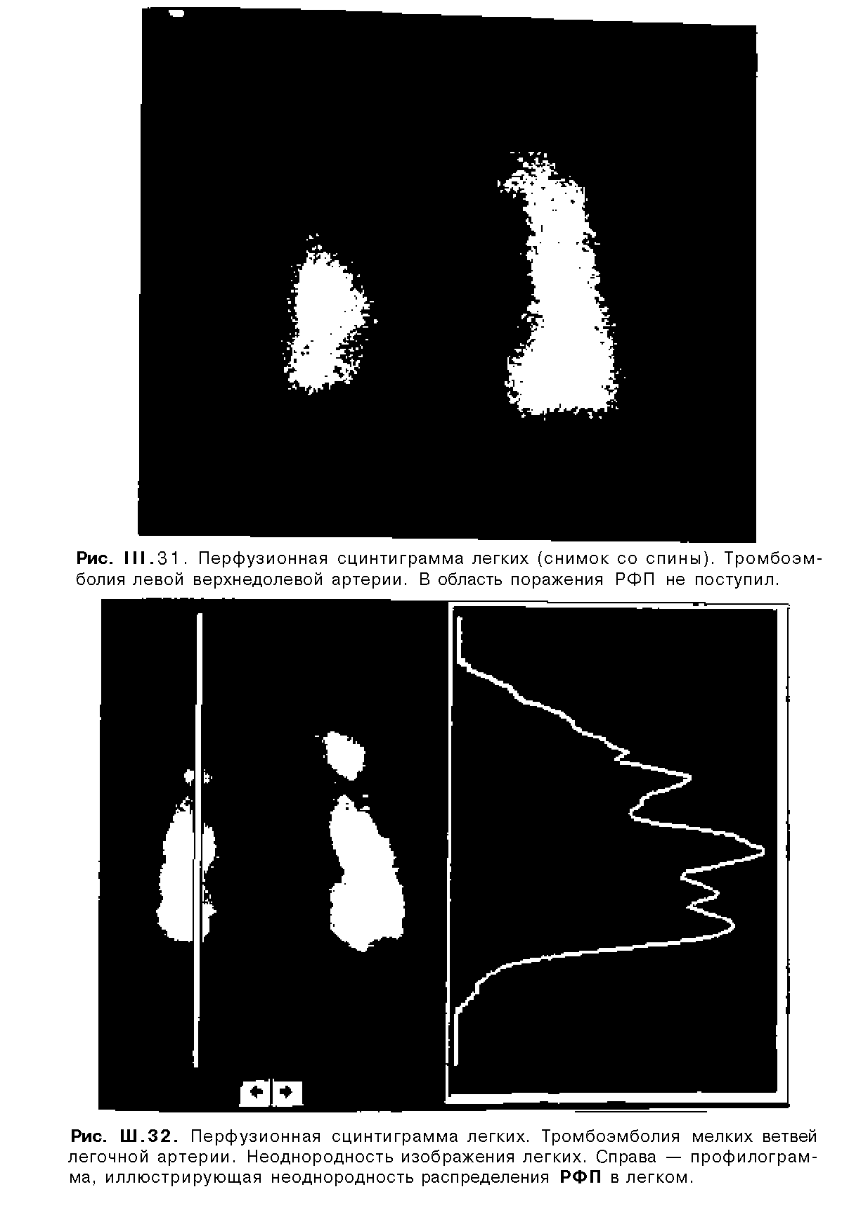 Рис. Ш.32. Перфузионная сцинтиграмма легких. Тромбоэмболия мелких ветвей легочной артерии. Неоднородность изображения легких. Справа — профилограмма, иллюстрирующая неоднородность распределения РФП в легком.