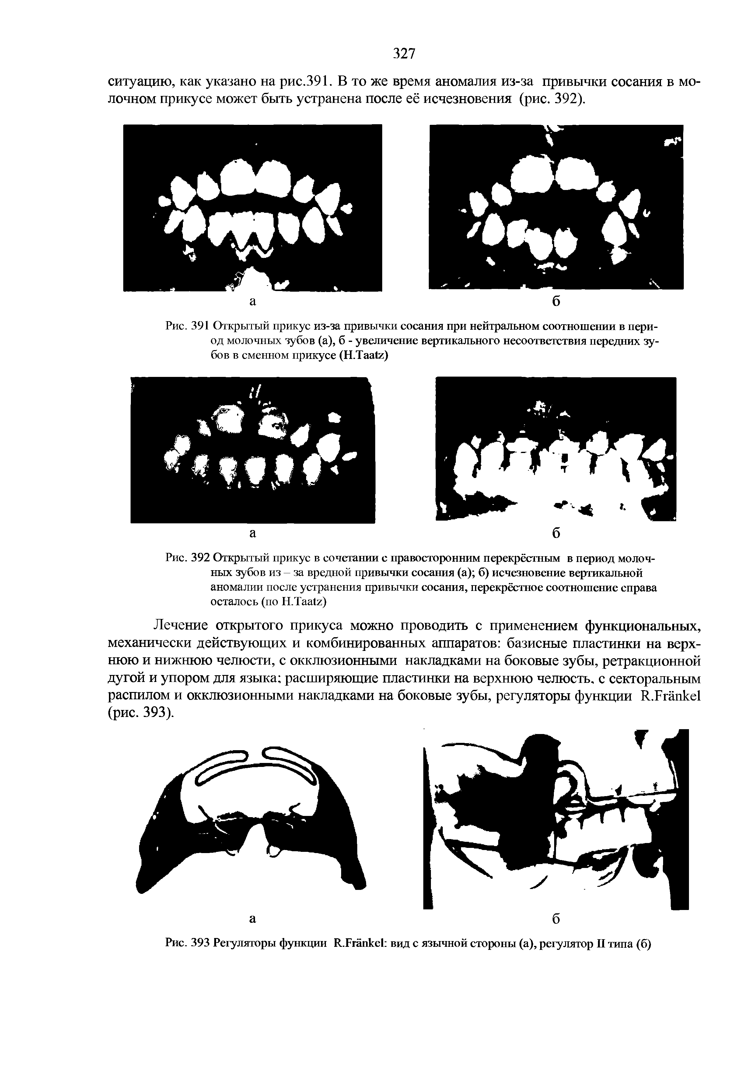 Рис. 392 Открытый прикус в сочетании с правосторонним перекрёстным в период молочных зубов из за вредной привычки сосания (а) б) исчезновение вертикальной аномалии после устранения привычки сосания, перекрёстное соотношение справа осталось (по П.Тагйх)...