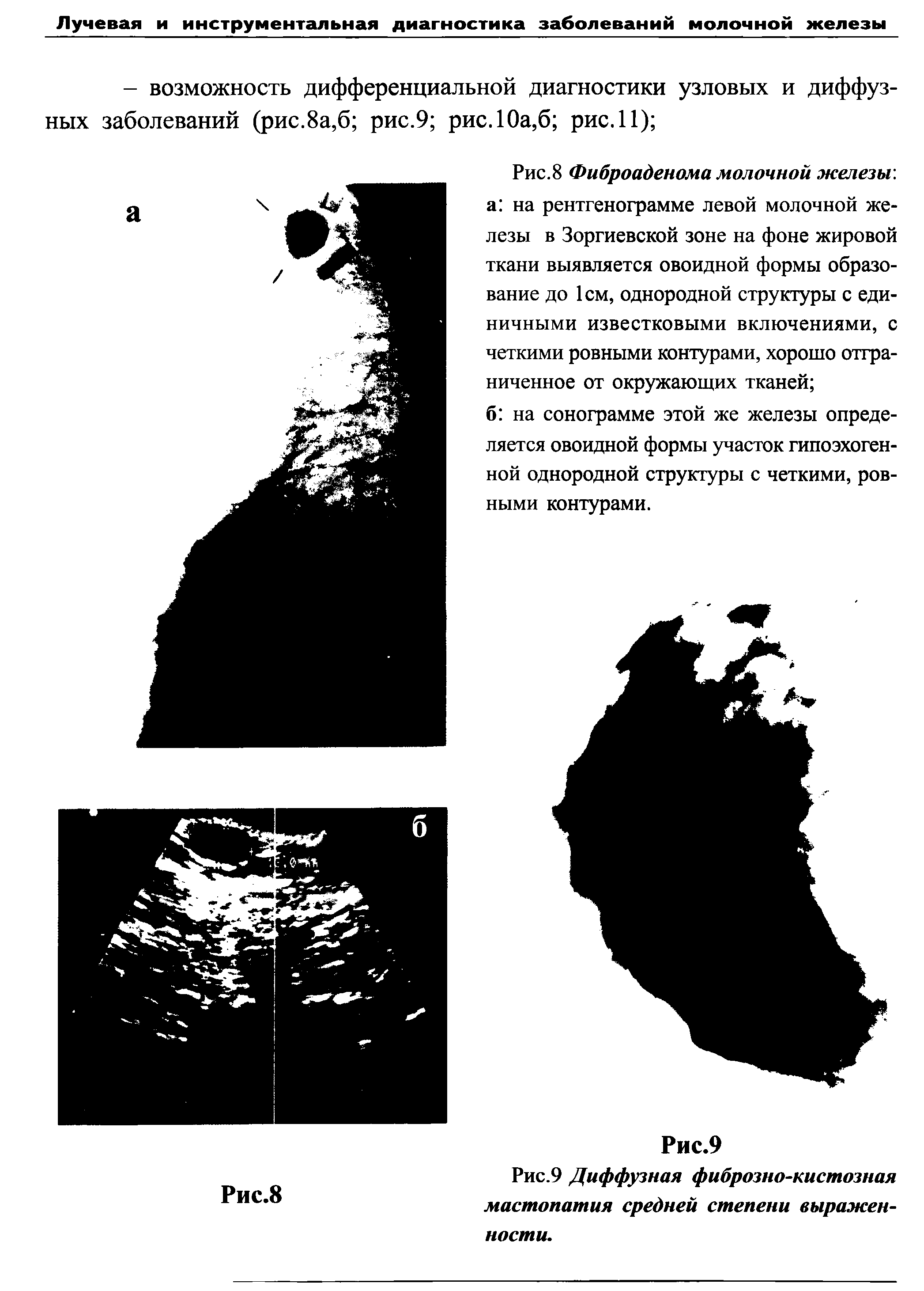 Рис.8 Фиброаденома молочной железы. а на рентгенограмме левой молочной железы в Зоргиевской зоне на фоне жировой ткани выявляется овоидной формы образование до 1см, однородной структуры с единичными известковыми включениями, с четкими ровными контурами, хорошо отграниченное от окружающих тканей ...