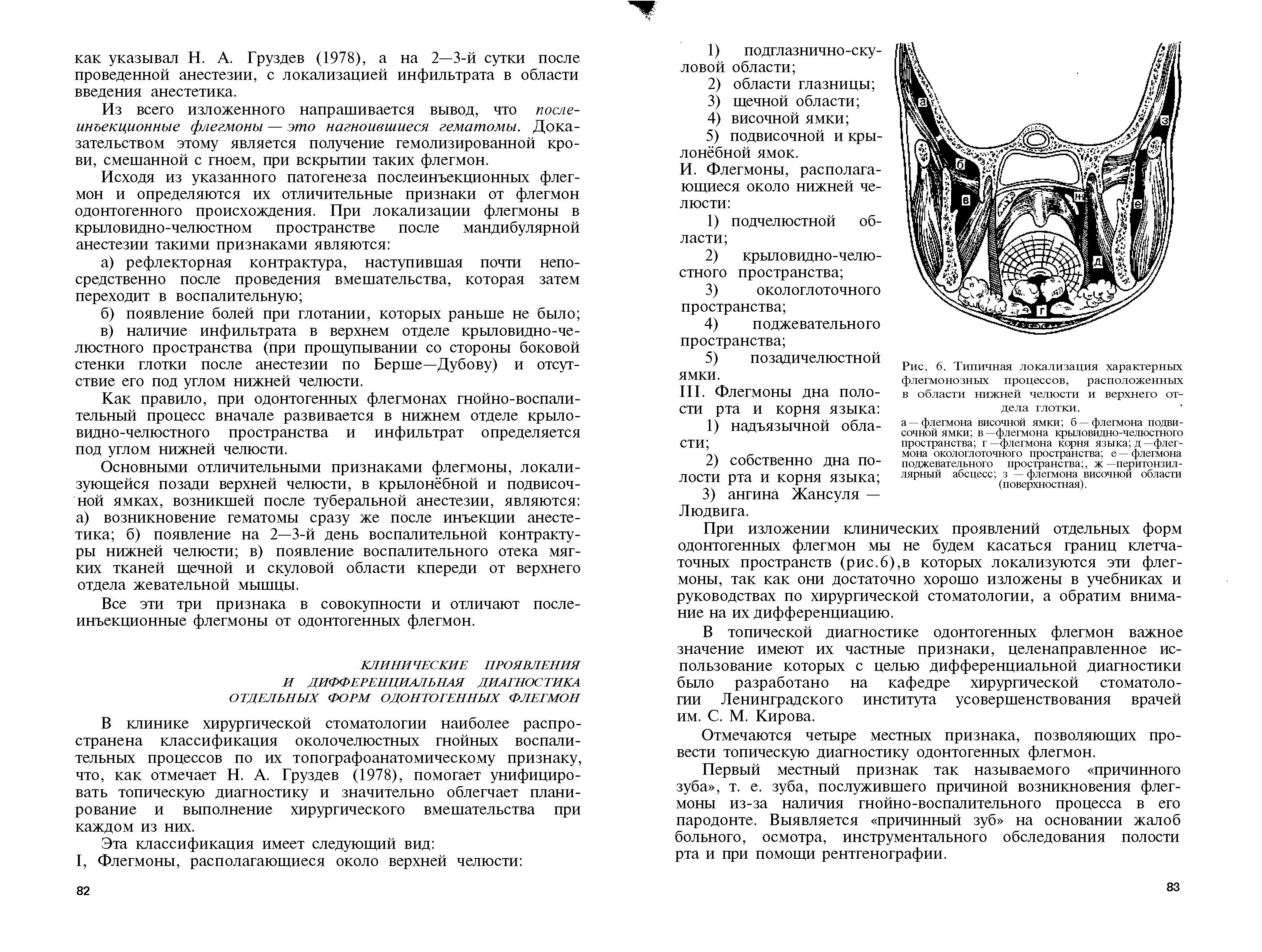 Рис. 6. Типичная локализация характерных флегмонозных процессов, расположенных в области нижней челюсти и верхнего отдела глотки.