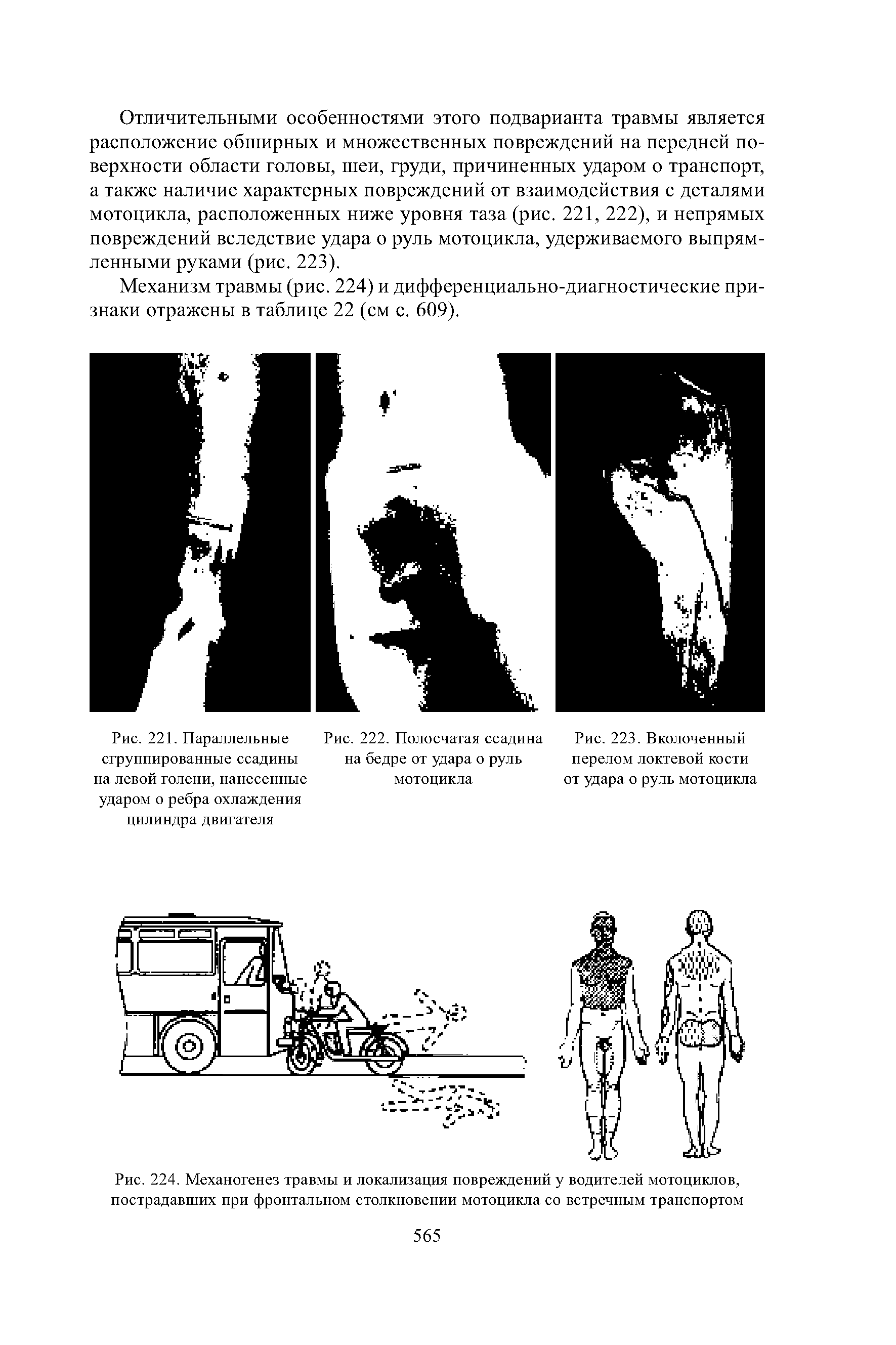 Рис. 224. Механогенез травмы и локализация повреждений у водителей мотоциклов, пострадавших при фронтальном столкновении мотоцикла со встречным транспортом...