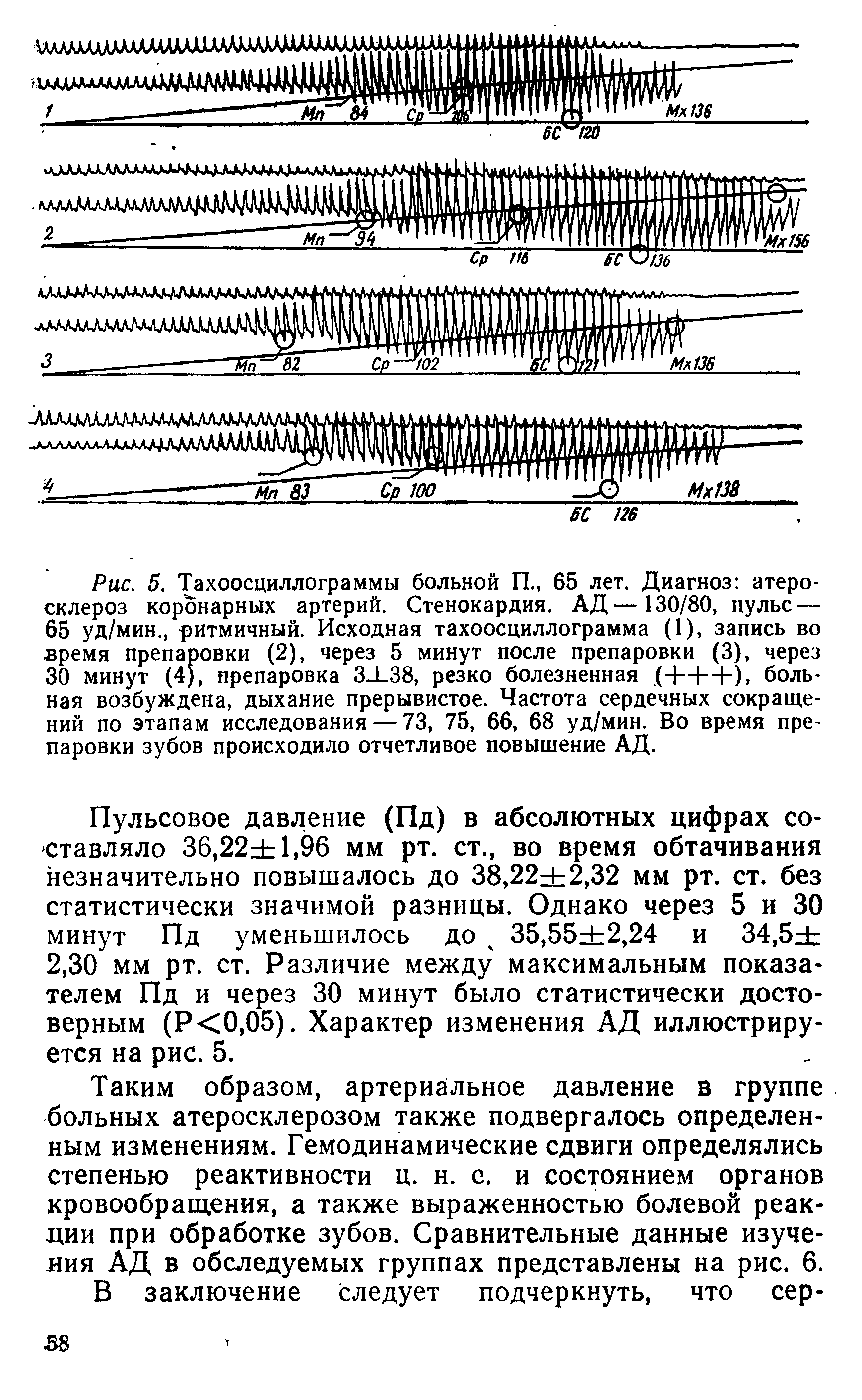 Рис. 5. Тахоосциллограммы больной П., 65 лет. Диагноз атеросклероз коронарных артерий. Стенокардия. АД— 130/80, пульс — 65 уд/мин ритмичный. Исходная тахоосциллограмма (1), запись во время препаровки (2), через 5 минут после препаровки (3), через 30 минут (4), препаровка 3 1 38, резко болезненная. (+++), больная возбуждена, дыхание прерывистое. Частота сердечных сокращений по этапам исследования — 73, 75, 66, 68 уд/мин. Во время препаровки зубов происходило отчетливое повышение АД.