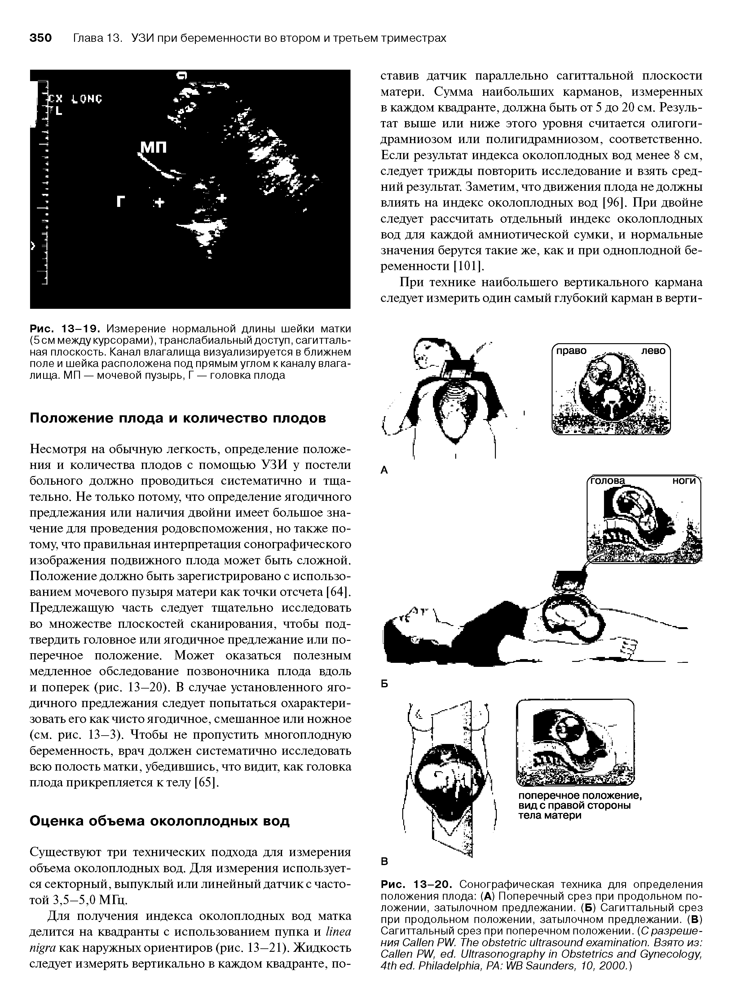 Рис. 13-19. Измерение нормальной длины шейки матки (5 см между курсорами), транслабиальный доступ, сагиттальная плоскость. Канал влагалища визуализируется в ближнем поле и шейка расположена под прямым углом к каналу влагалища. МП — мочевой пузырь, Г — головка плода...