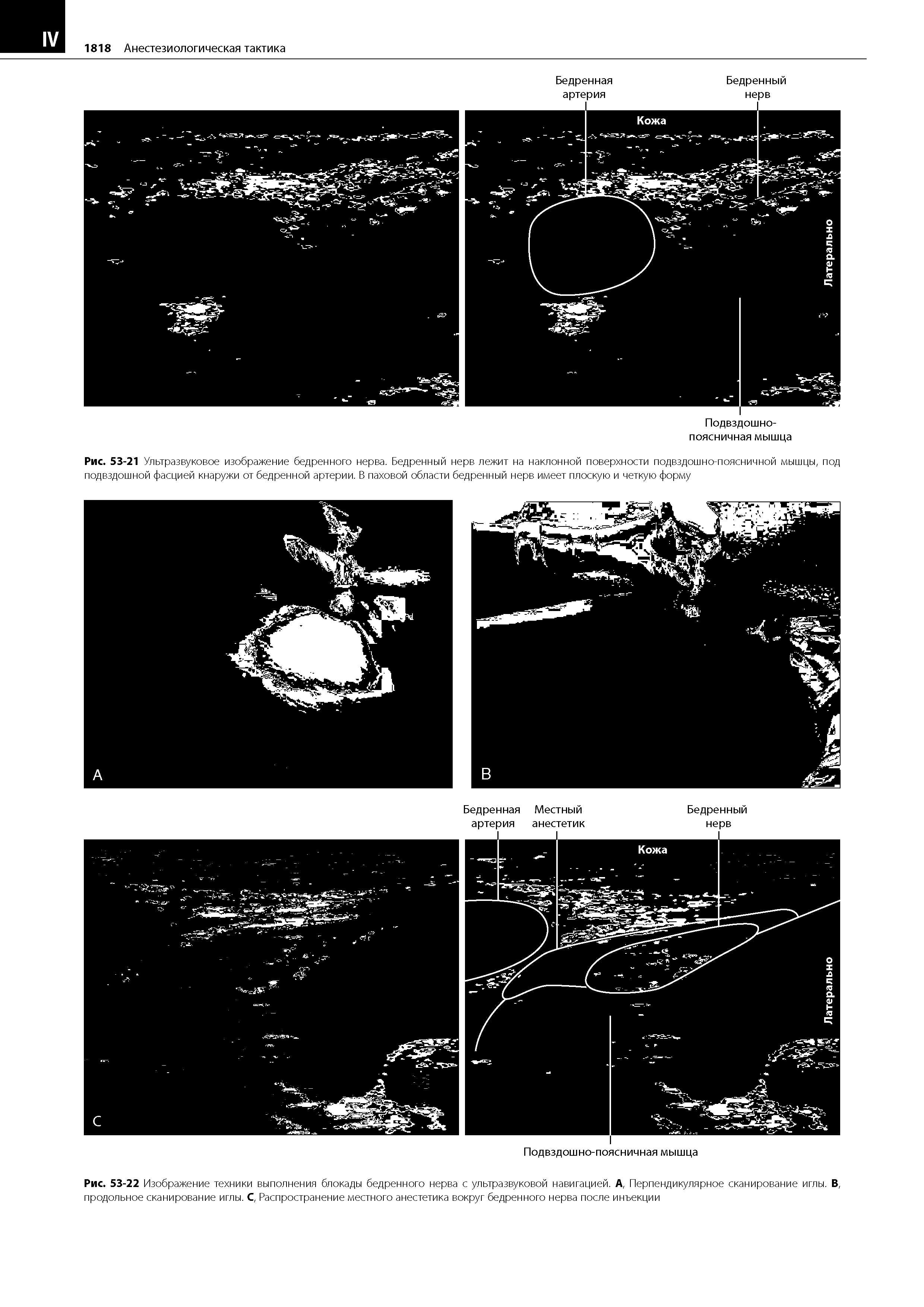 Рис. 53-22 Изображение техники выполнения блокады бедренного нерва с ультразвуковой навигацией. А, Перпендикулярное сканирование иглы. В, продольное сканирование иглы. С, Распространение местного анестетика вокруг бедренного нерва после инъекции...
