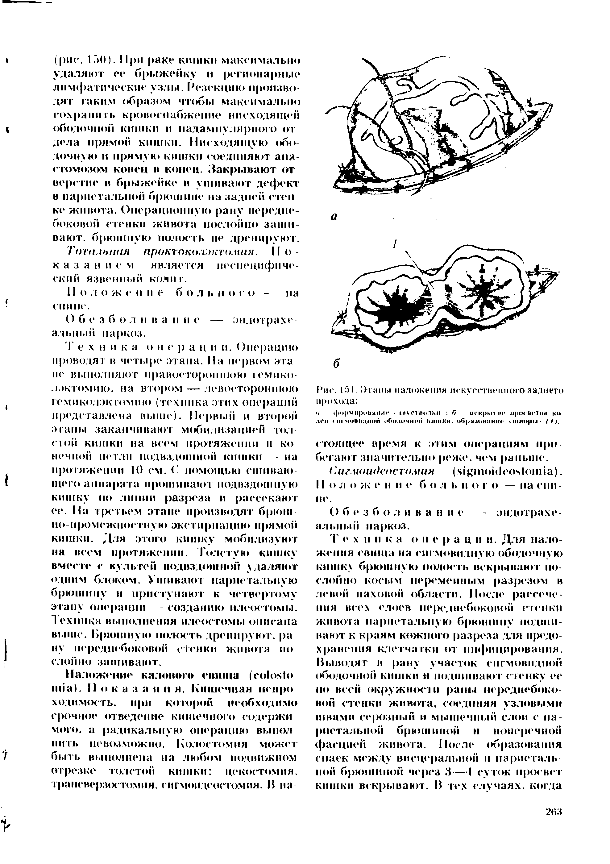 Рис. 151. Этапы наложения искусственного заднего прохода и < >< ми ювани 1КХСТНОЛКИ б вскрытие просветив ко лен < и мокидпой ободочной кишки, образование хшшфЫ- ( I).