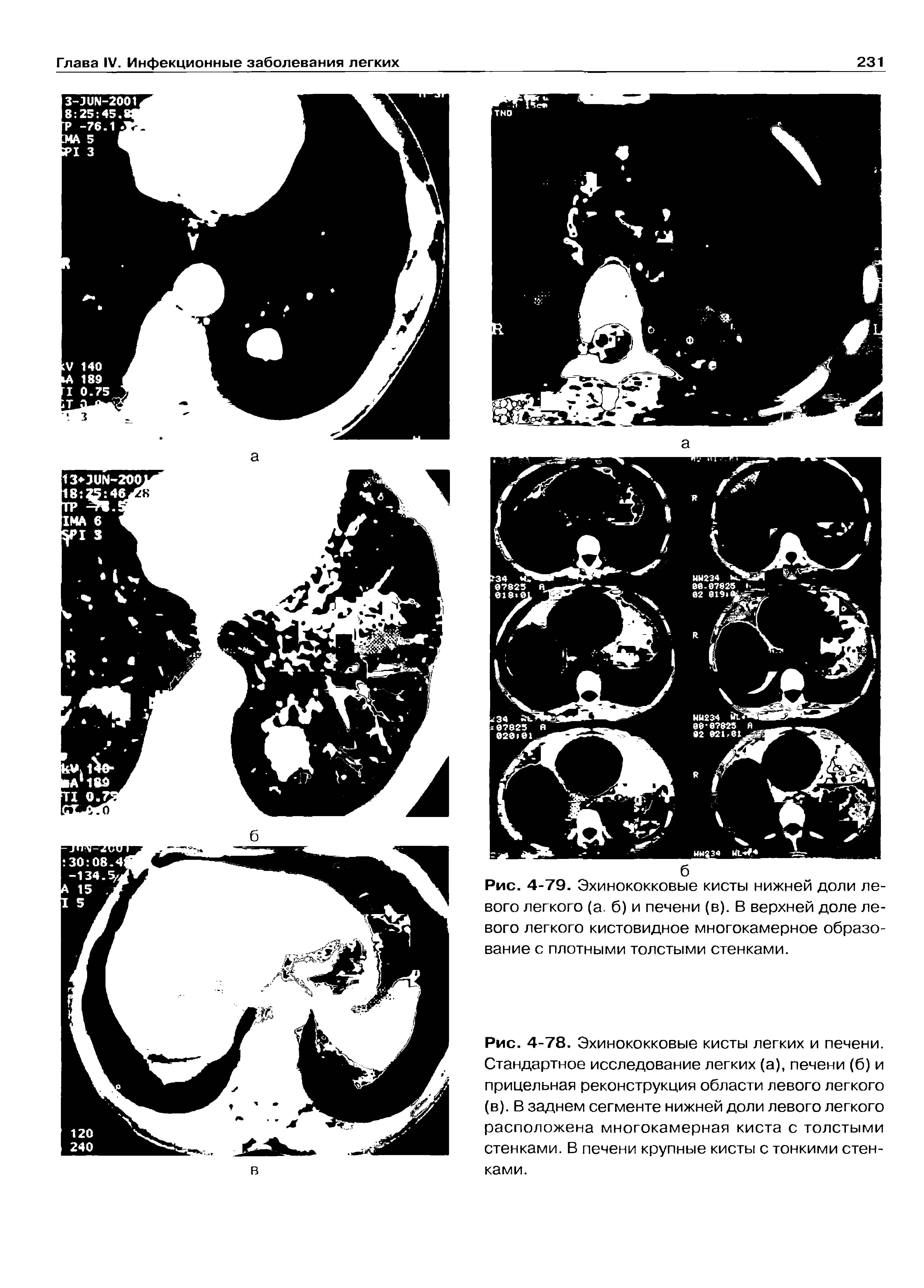 Рис. 4-79. Эхинококковые кисты нижней доли левого легкого (а. б) и печени (в). В верхней доле левого легкого кистовидное многокамерное образо-...