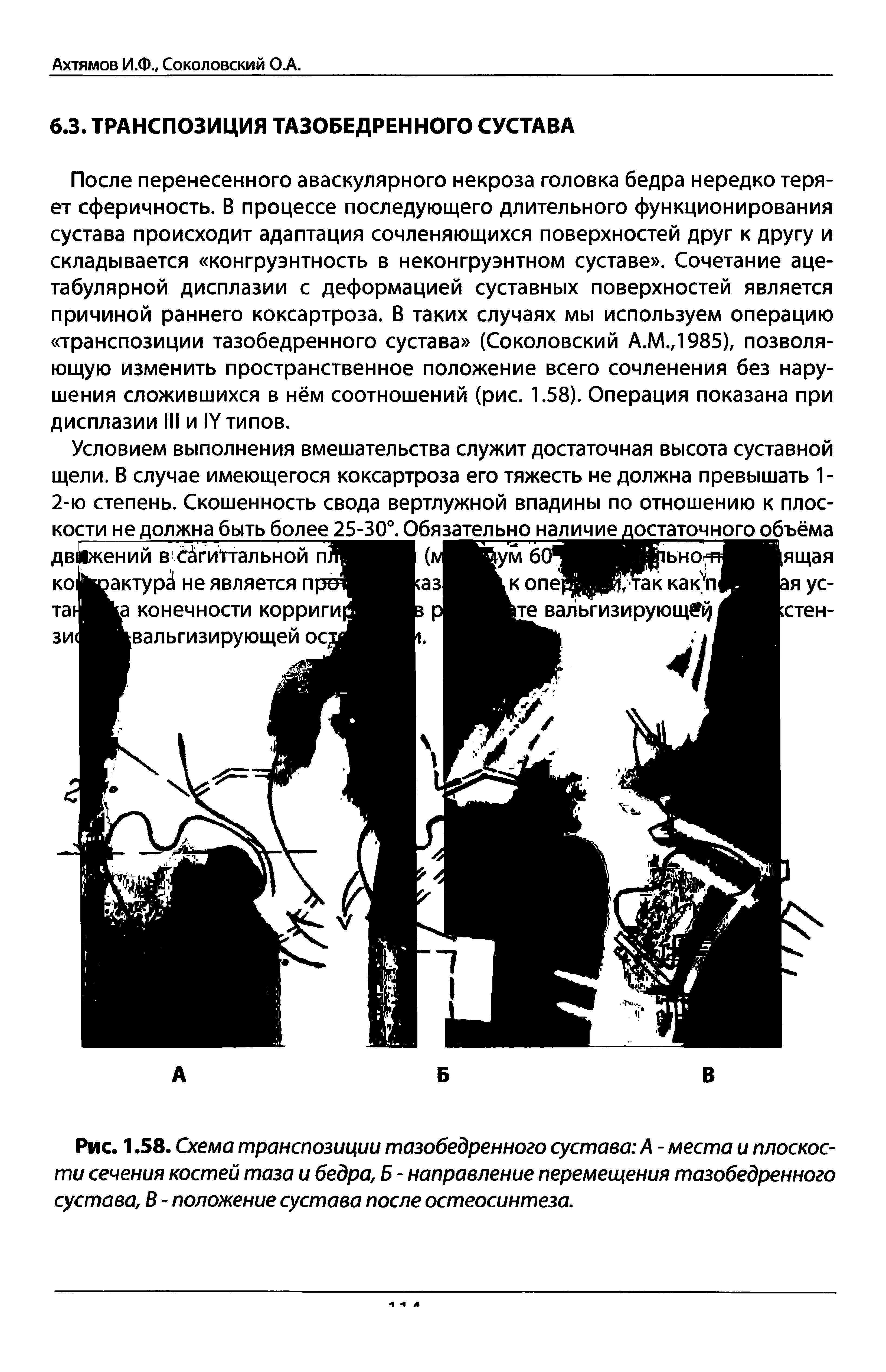 Рис. 1.58. Схема транспозиции тазобедренного сустава А - места и плоскости сечения костей таза и бедра, Б - направление перемещения тазобедренного сустава, В - положение сустава после остеосинтеза.