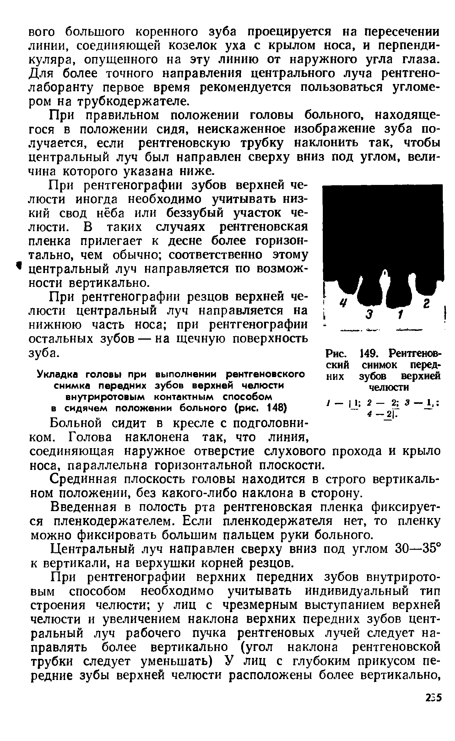 Рис. 149. Рентгеновский снимок передних зубов верхней челюсти...