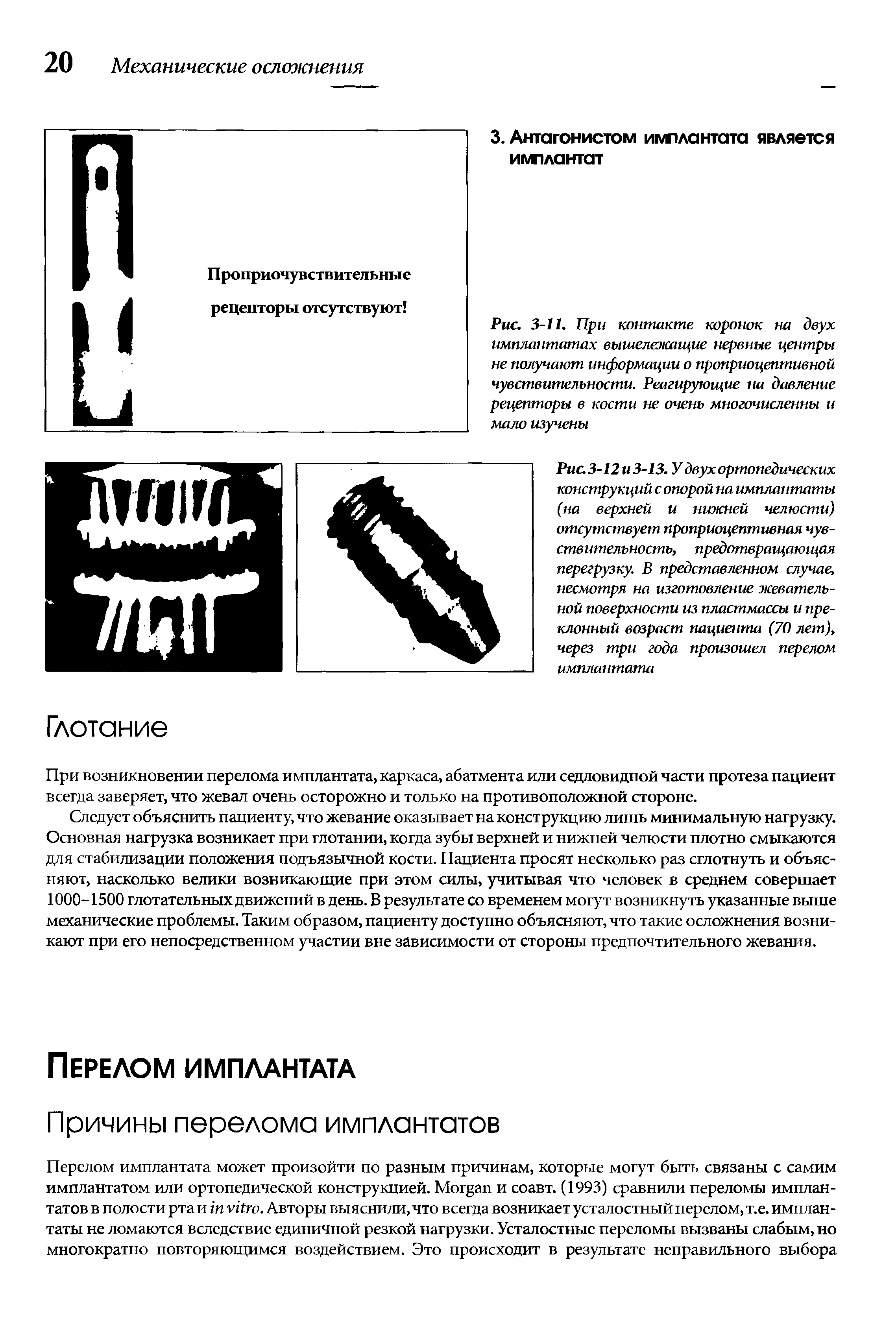 Рис. 3-11. При контакте коронок на двух имплантатах вышележащие нервные центры не получают информации о проприоцептивной чувствительности. Реагирующие на давление рецепторы в кости не очень многочисленны и мало изучены...