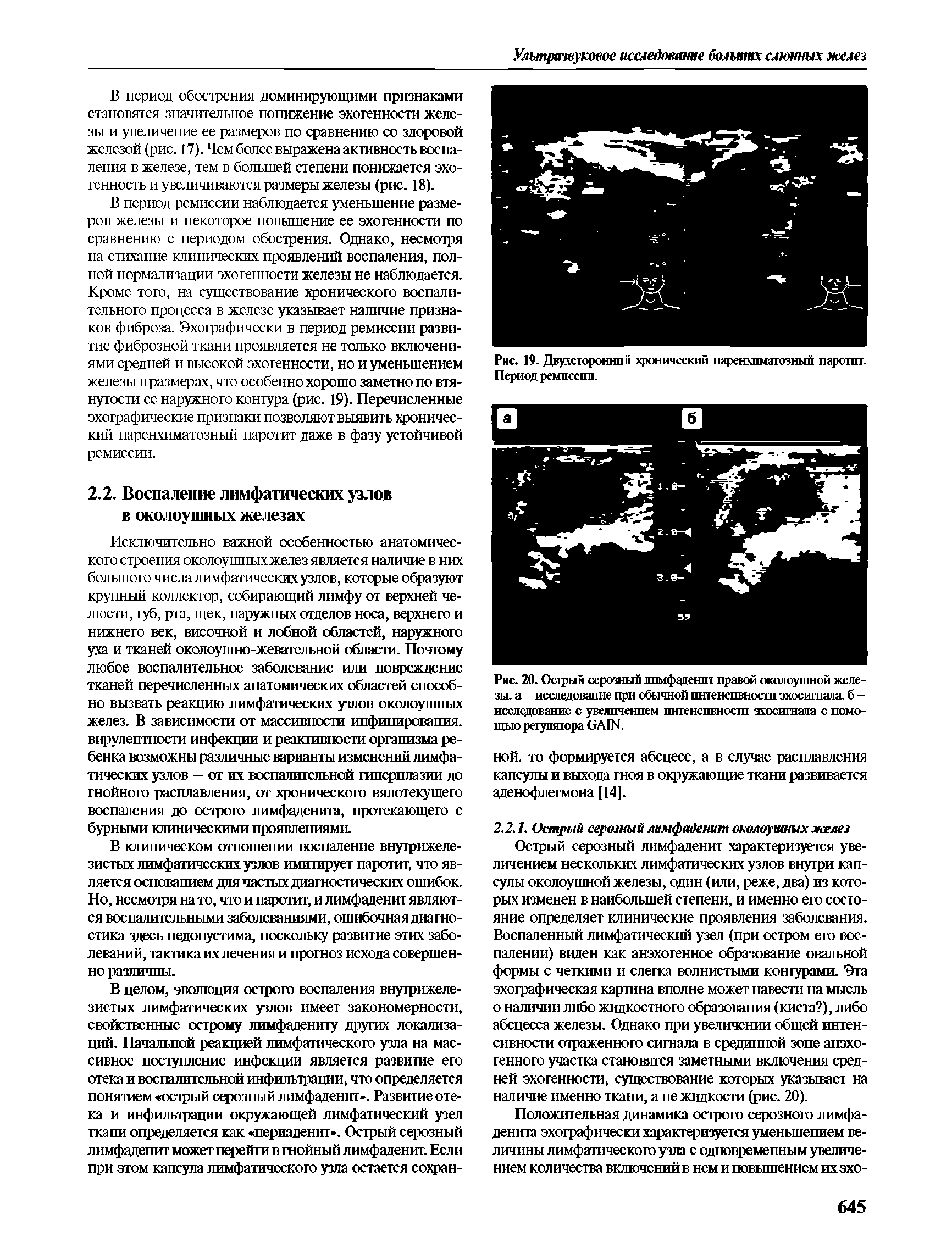 Рис. 20. Острый серозный лимфаденит правой околоушной железы. а— исследование при обычной пнтенспвностп эхосигнала. б -исследование с увеличением пнтенспвностп эхосигнала с помощью регулятора ОА ПЧ.