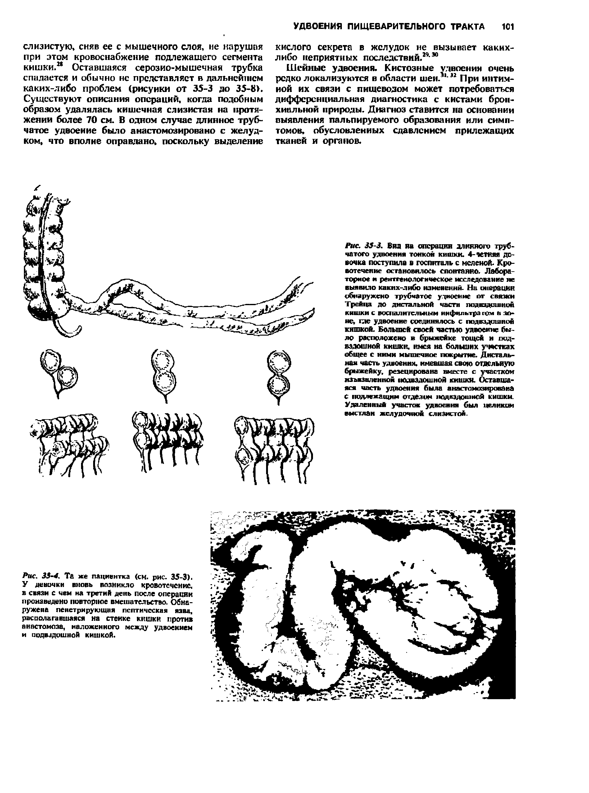 Рис. 3 -4. Та же пациентка (см. рис. 35-3). У девочки вновь возникло кровотечение, в связи с чем на третий день после операции произведено повторное вмешательство. Обнаружена пенетрирующмя пептическая язва, располагавшаяся на стейке ккшкн против анастомоза, наложенного между удвоением И ПОДВЗДОШНОЙ КИШКОЙ.