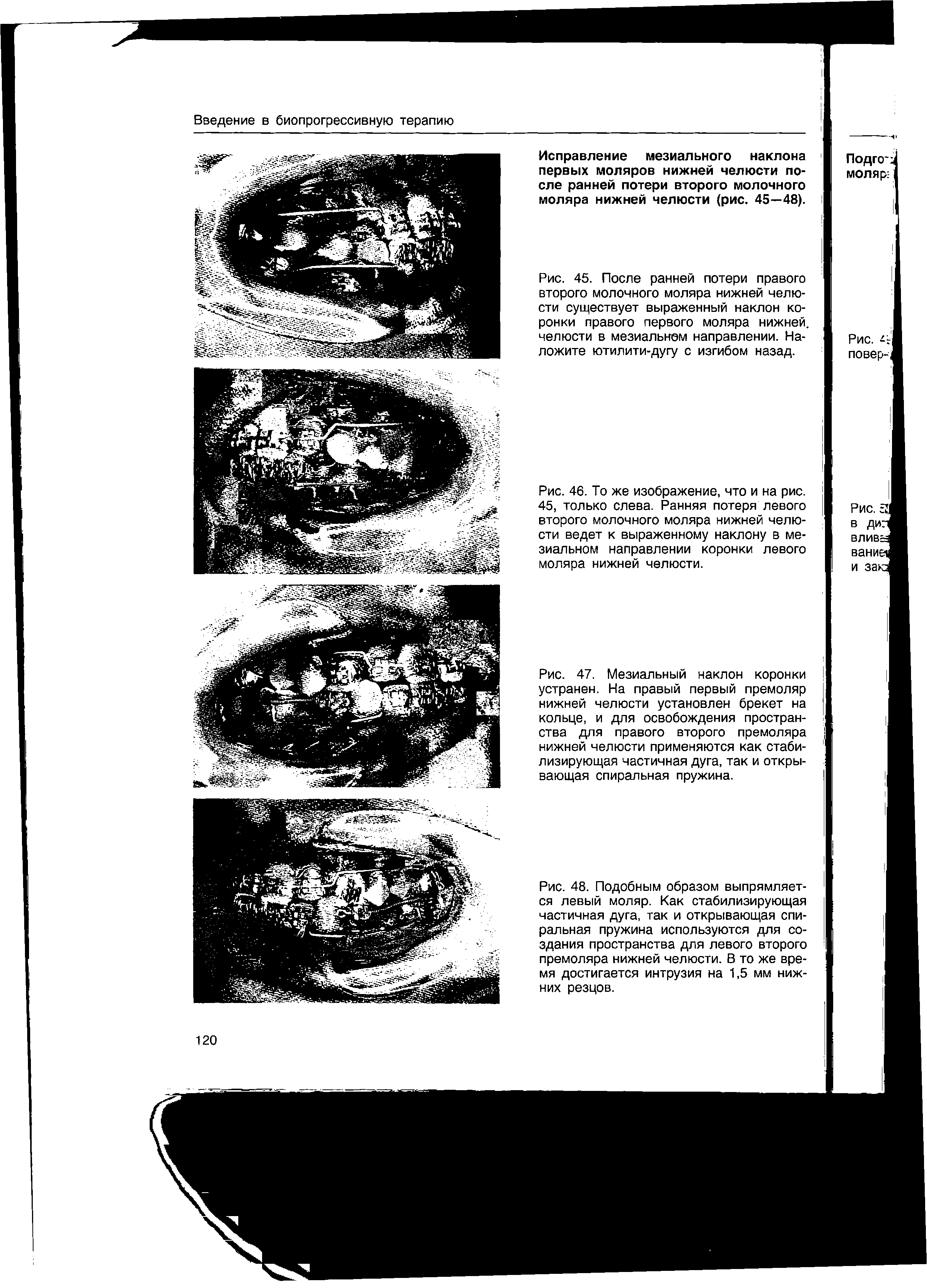 Рис. 48. Подобным образом выпрямляется левый моляр. Как стабилизирующая частичная дуга, так и открывающая спиральная пружина используются для создания пространства для левого второго премоляра нижней челюсти. В то же время достигается интрузия на 1,5 мм нижних резцов.