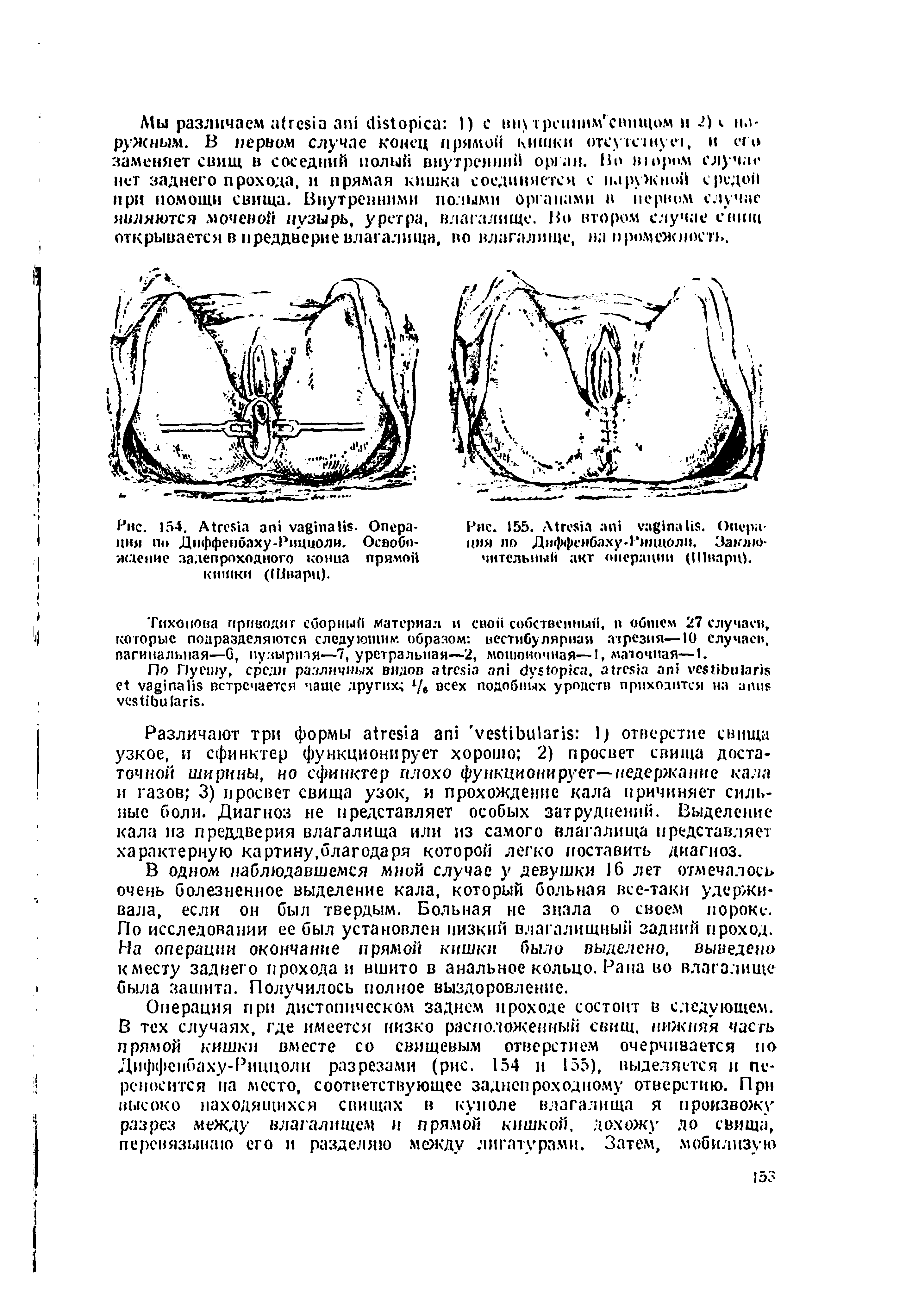 Рис. 155. A . Опера имя по Дмффембаху ),мццоли. Заклм>-чительный акт операции (Шварц).