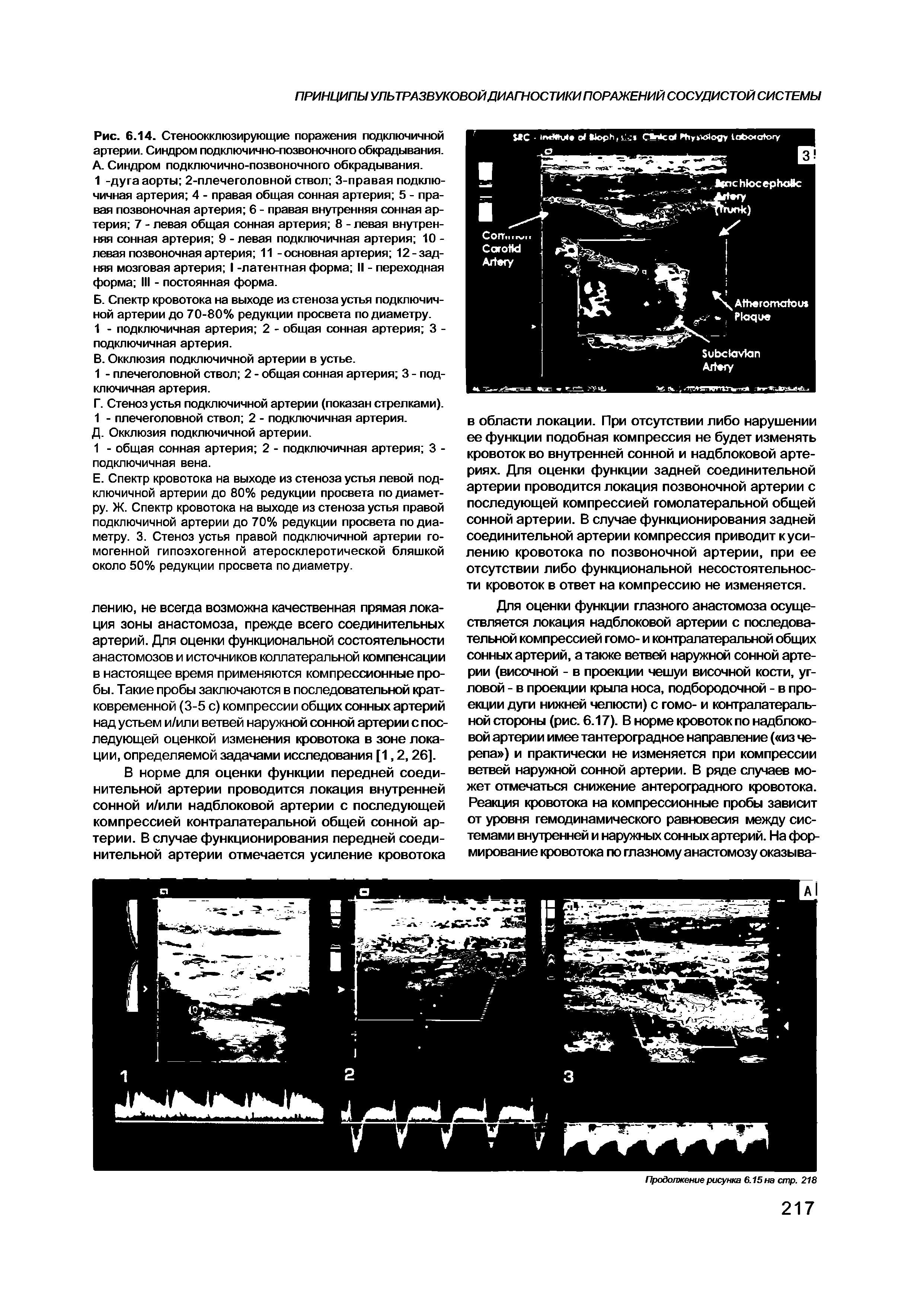 Рис. 6.14. Стеноокклюзирующие поражения подключичной артерии. Синдром подключично-позвоночного обкрадывания.