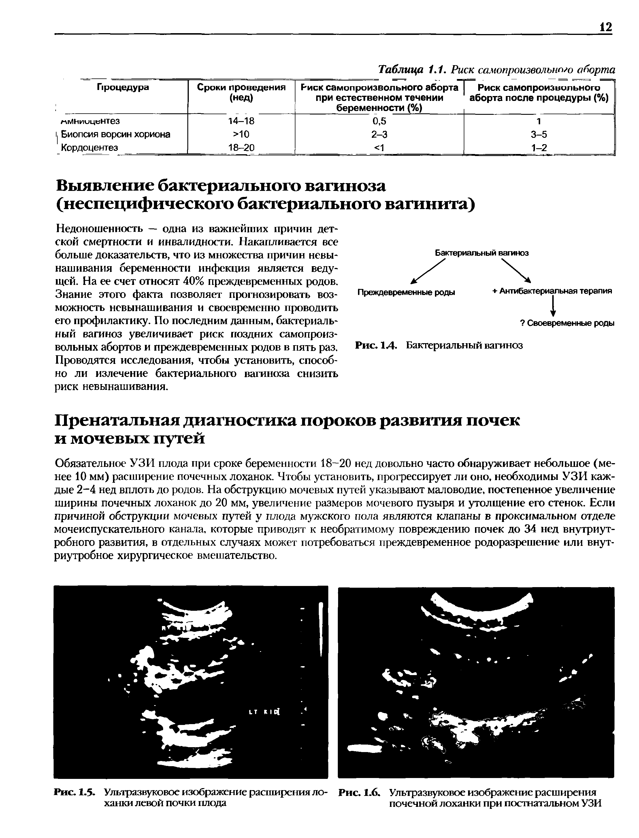 Рис. 1.5. Ультразвуковое изображение расширения ло- Рис. 1.6. Ультразвуковое изображение расширения ханки левой почки плода почечной лоханки при постнатальном УЗИ...