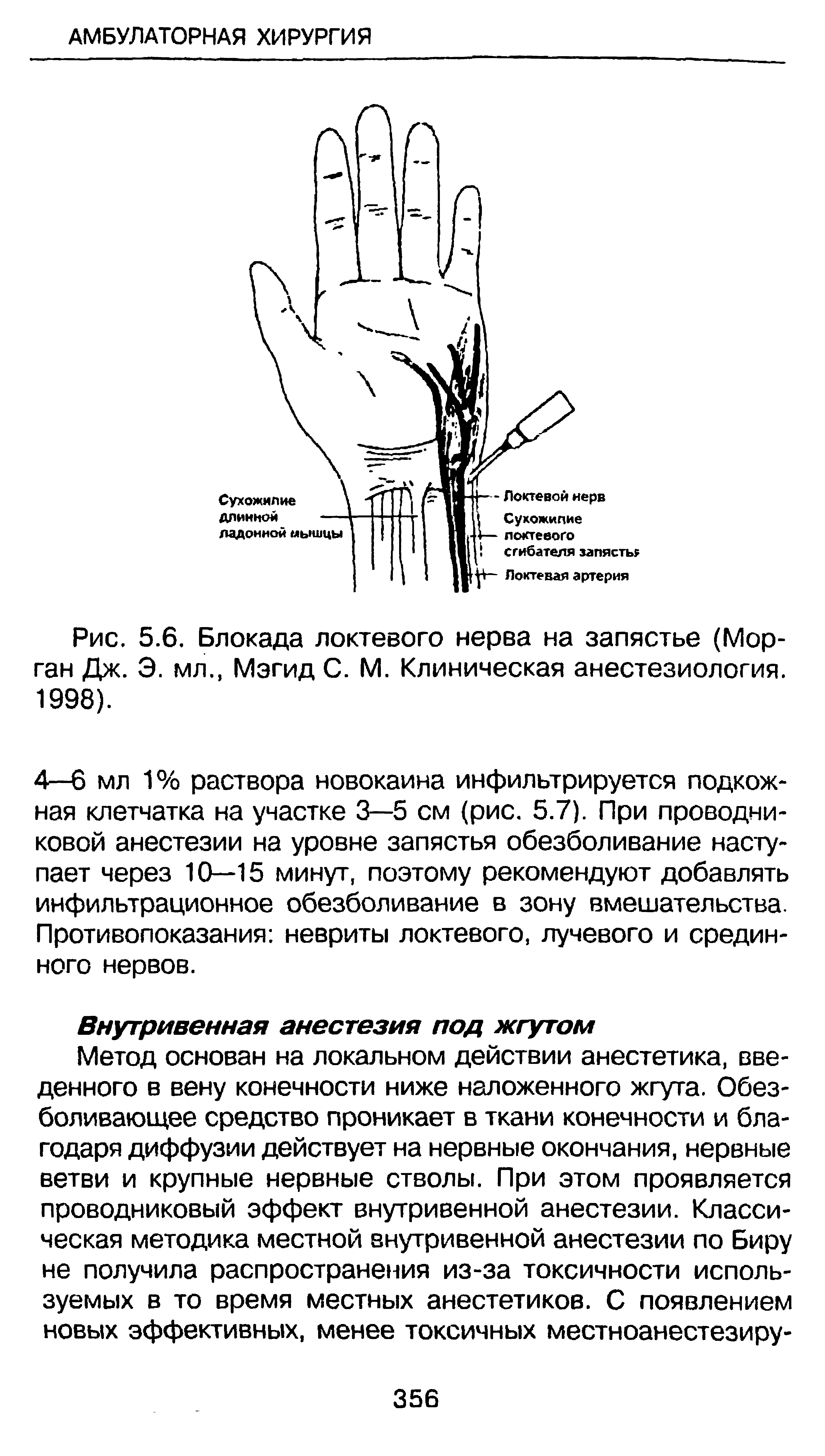 Рис. 5.6. Блокада локтевого нерва на запястье (Морган Дж. Э. мл., Мэгид С. М. Клиническая анестезиология. 1998).