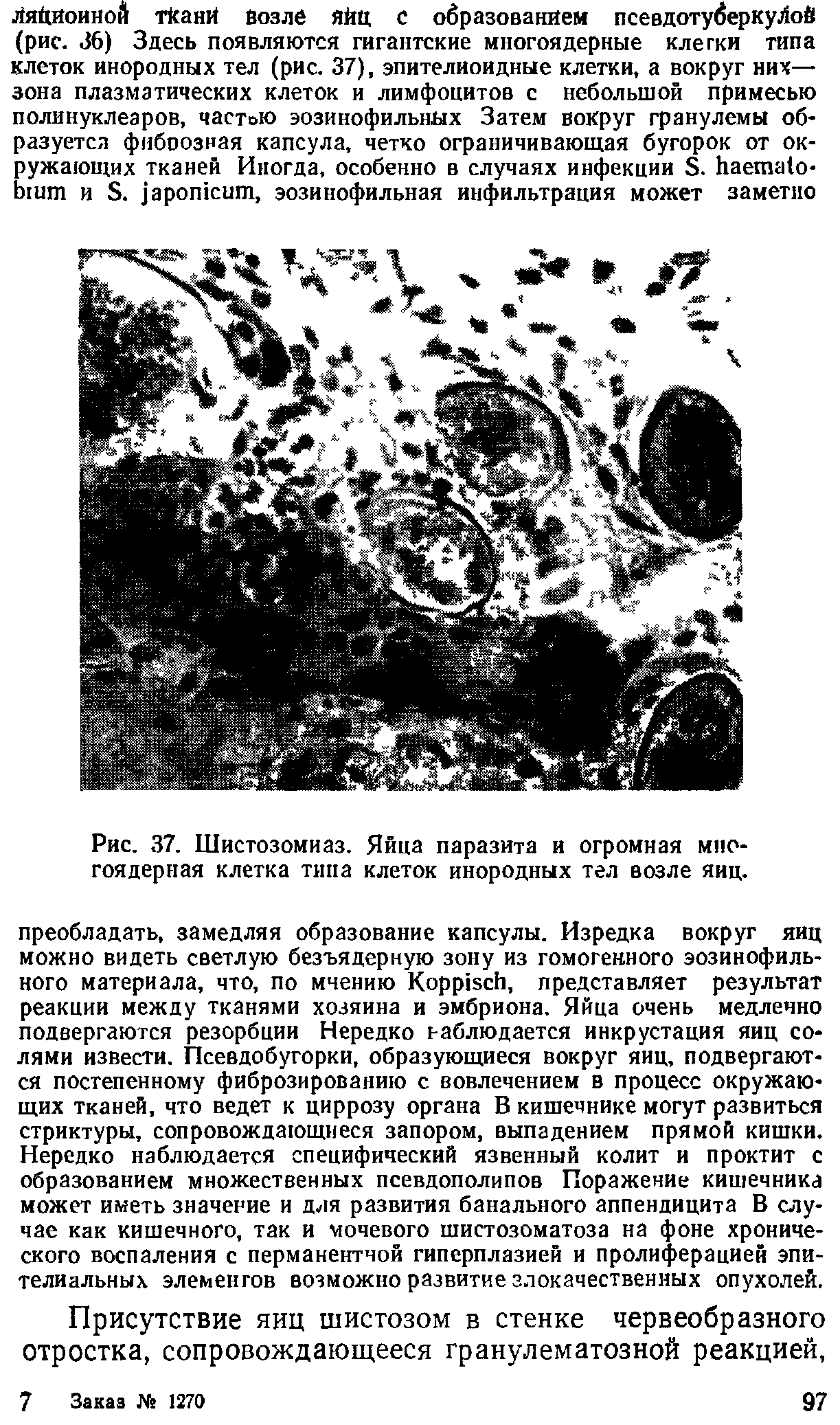 Рис. 37. Шистозомиаз. Яйца паразита и огромная многоядерная клетка типа клеток инородных тел возле яиц.