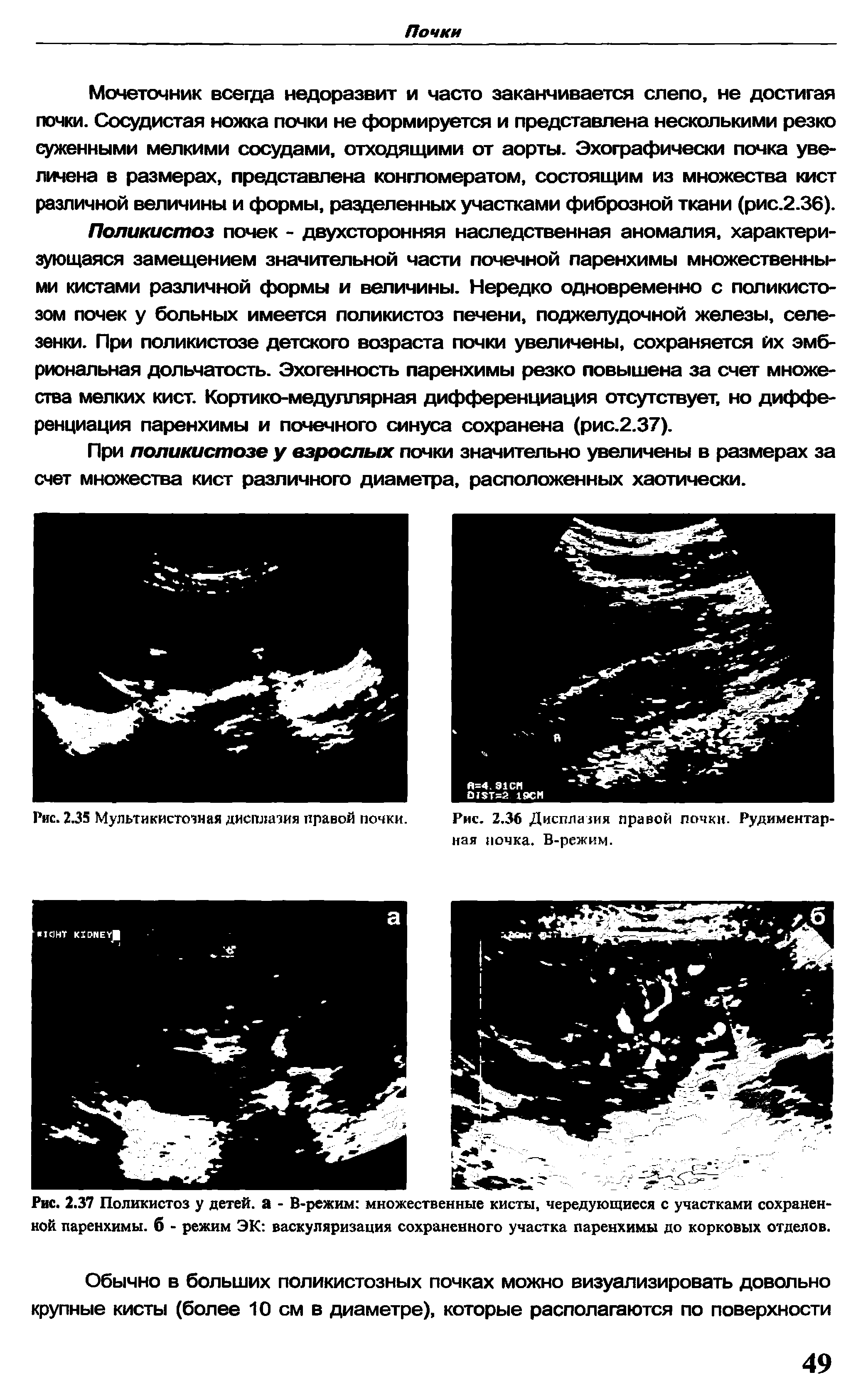 Рис. 2.37 Поликистоз у детей, а - В-режим множественные кисты, чередующиеся с участками сохраненной паренхимы, б - режим ЭК васкуляризация сохраненного участка паренхимы до корковых отделов.