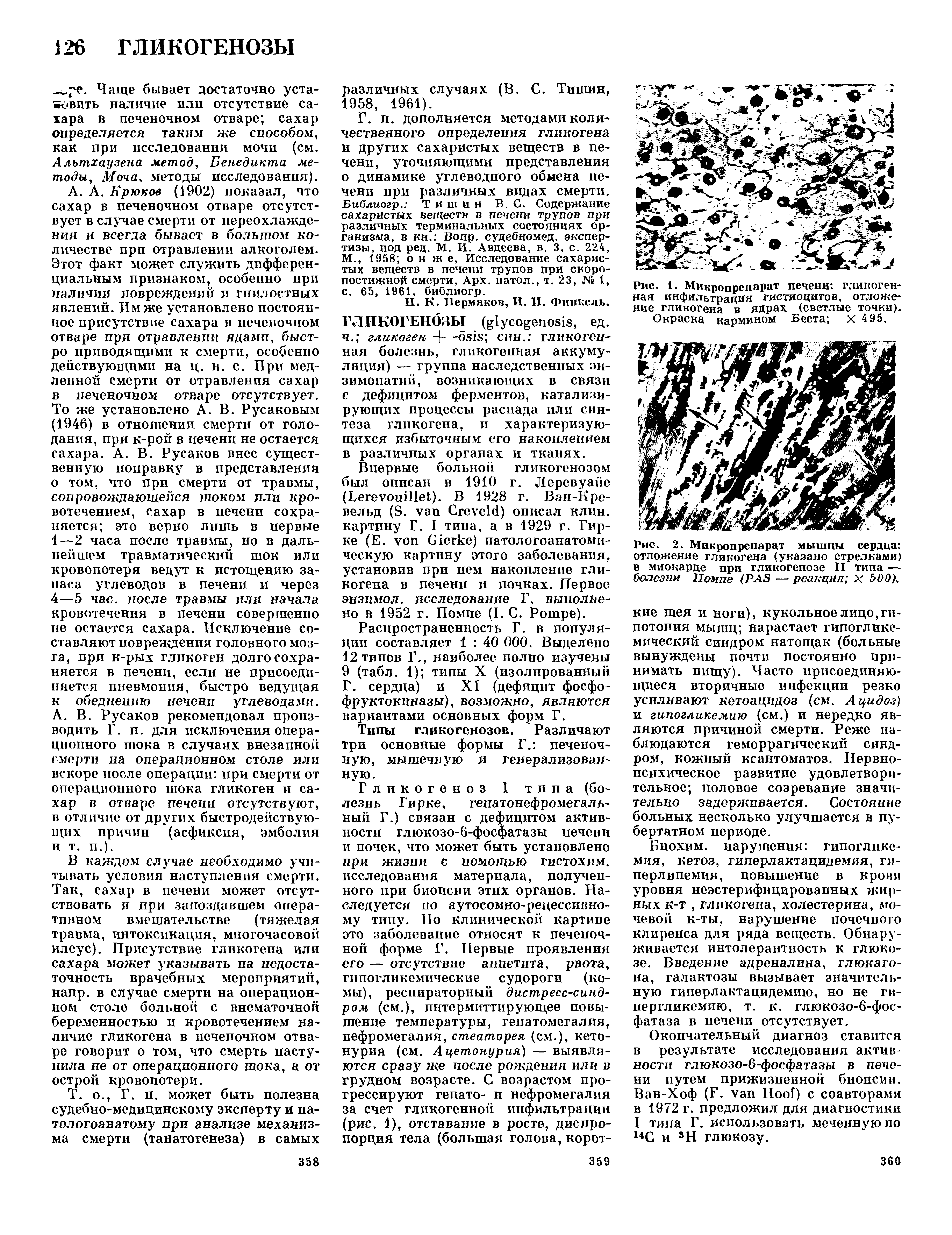 Рис. 2. Микропрепарат мышцы сердца отложение гликогена (указано стрелками) в миокарде при гликогенозе II типа — бааезни Помпе (PAS — реакция X 600).