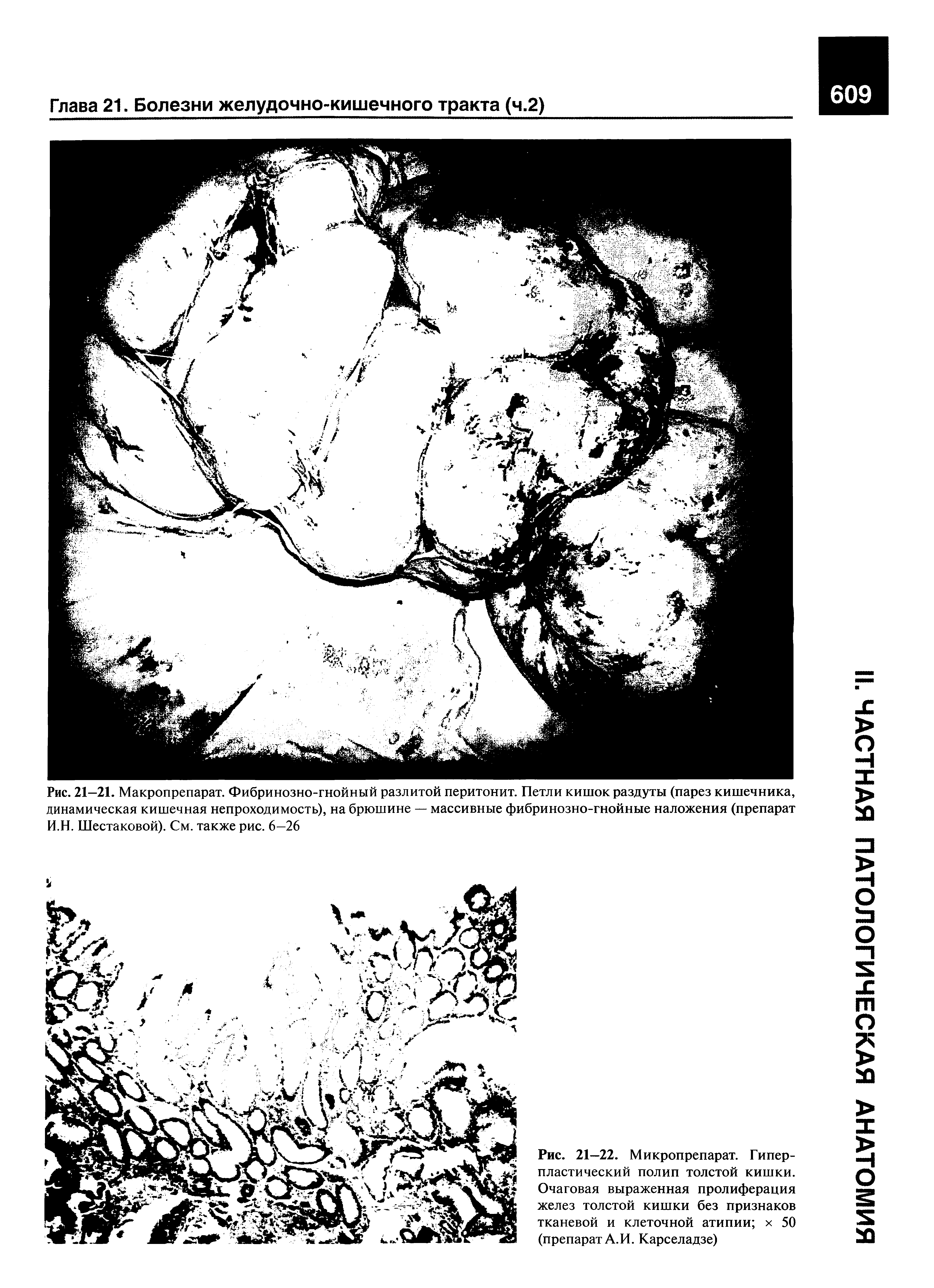 Рис. 21-21. Макропрепарат. Фибринозно-гнойный разлитой перитонит. Петли кишок раздуты (парез кишечника, динамическая кишечная непроходимость), на брюшине — массивные фибринозно-гнойные наложения (препарат И.Н. Шестаковой). См. также рис. 6—26...