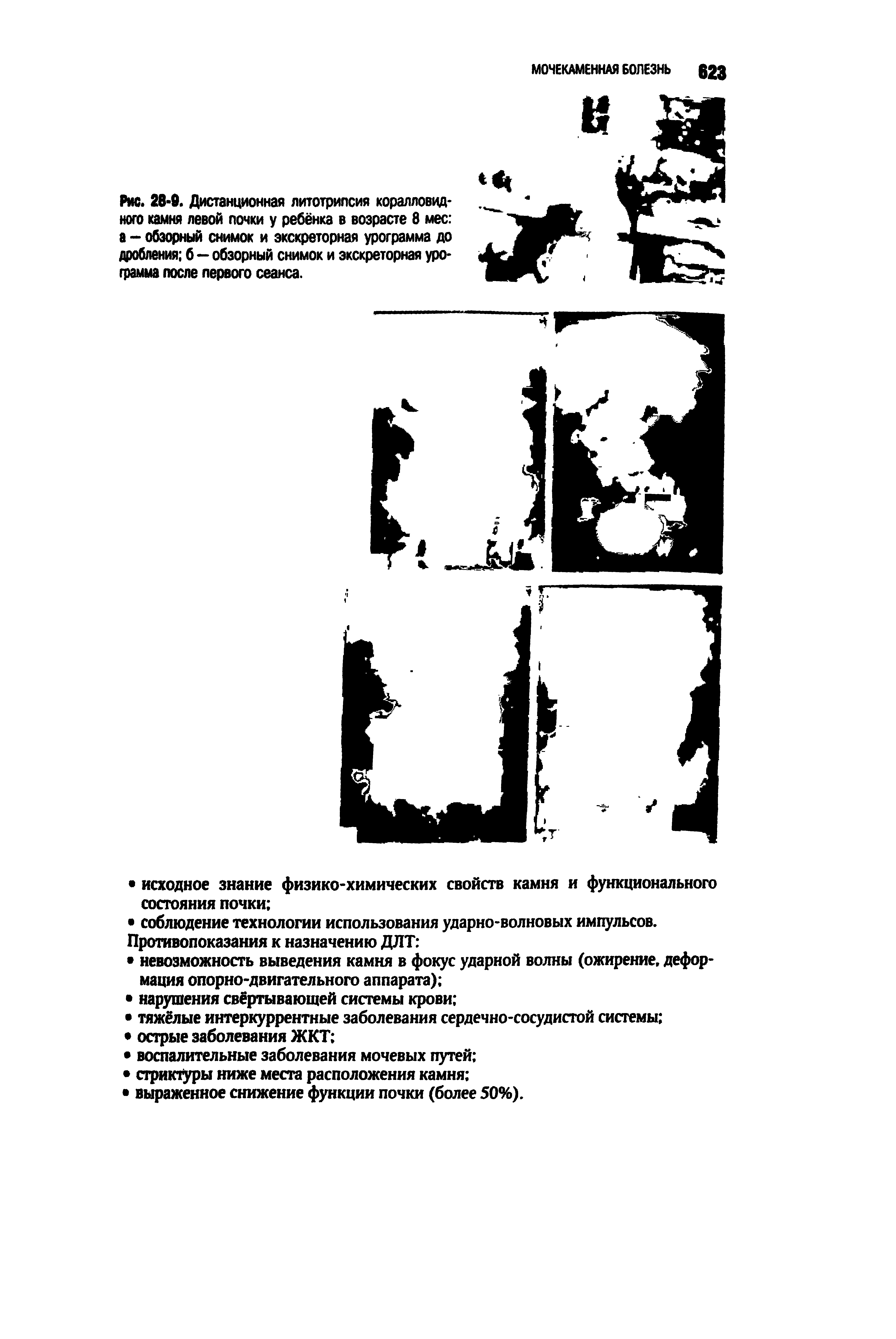 Рис. 28-0. Дистанционная литотрипсия коралловидного камня левой почки у ребёнка в возрасте 8 мес а - обзорный снимок и экскреторная урограмма до дробления б—обзорный снимок и экскреторная урограмма после первого сеанса.