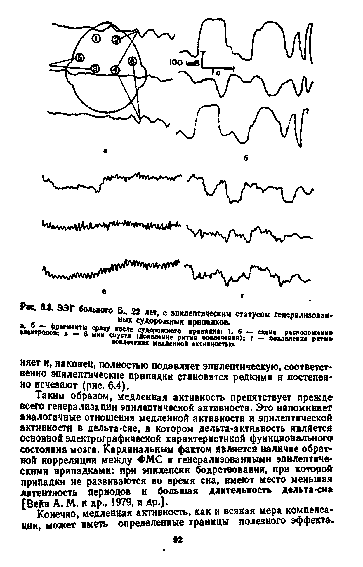 Рис. 6.Х ЭЭГ вольного Б., 22 лет, с епилептическнм статусом генерализованных судорожных припадков.