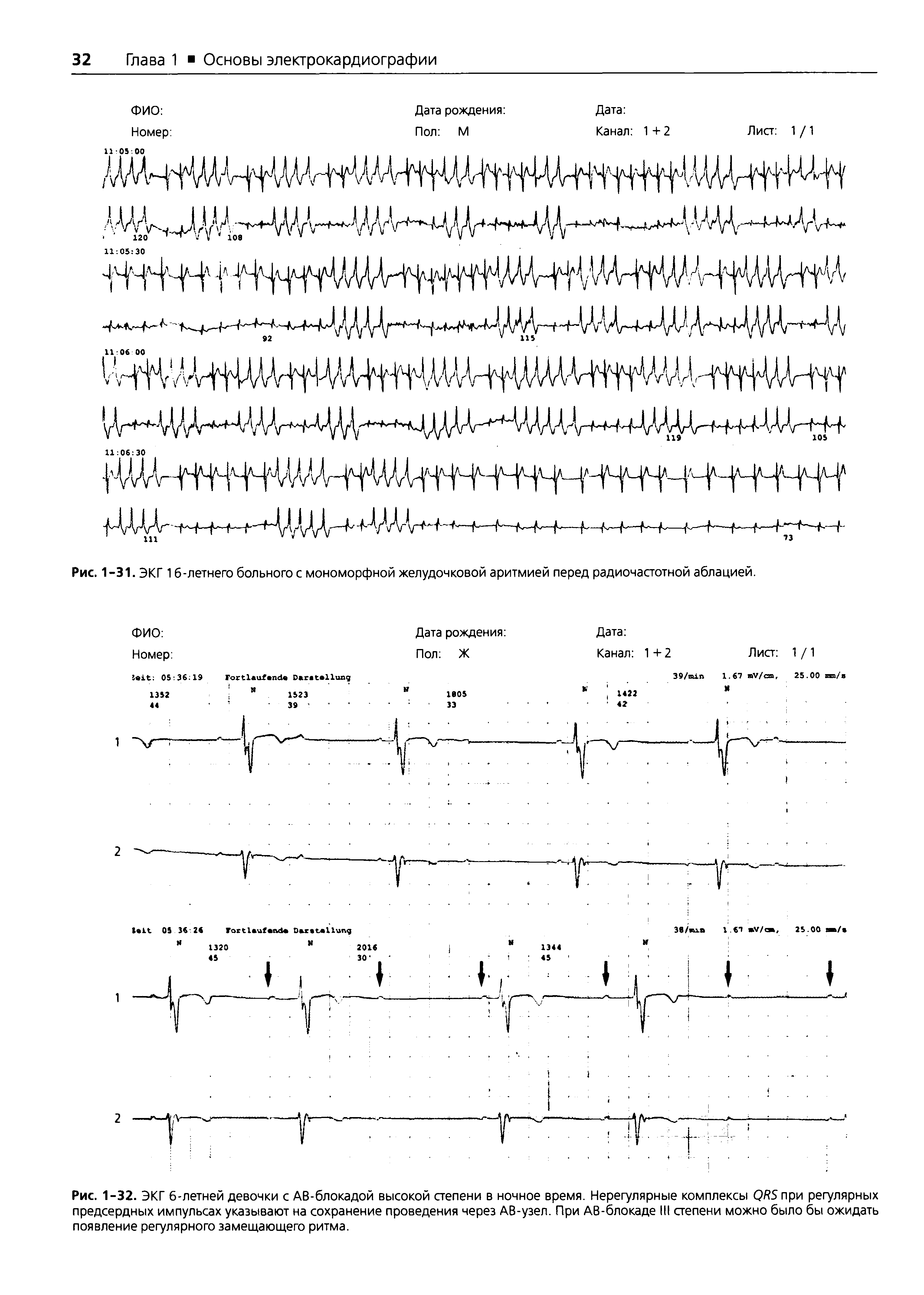 Рис. 1-31. ЭКГ 1 б-летнего больного с мономорфной желудочковой аритмией перед радиочастотной аблацией.